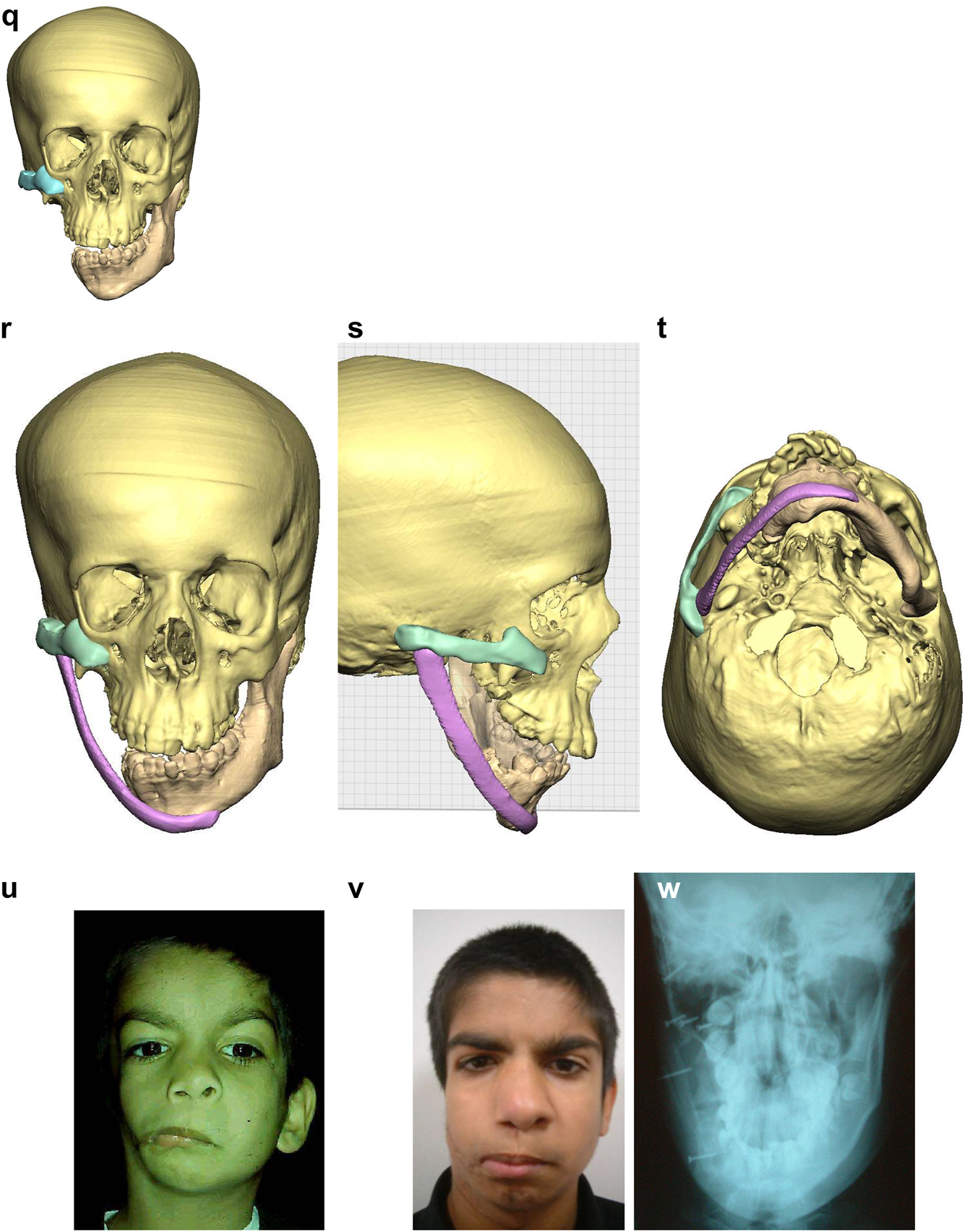 Figure 6: 
Planning for construction of missing zygomatic bone, glenoid fossa and mandible. (q) Simulation in freeform of the mandible having been swung to the left hinged on the normal left TMJ. (r–t) Simulation in freeform of contoured right costo-chondral graft to construct the right mandible (harvested from the left 6th or 7th rib which assists the correct contour). These constructs may be 3D printed and sterilised to act as a guide for contouring of the rib grafts during surgery or 3D sterilisable guides are made. It should be noted that there are potential areas of undesirably contact between the mandibular rib graft and the stump of the residual zygomatic bone and the mastoid bone and these need to be addressed at surgery. Also in these long reconstructions of the mandible, there is commonly a v-shaped defect at the point where the graft approximates to the mandible. It is good to pack that defect with further pieces of rib as shown in Figure 6n and Figure 7b. (u) Same case as Figure 2c and most of Figure 6 PK III with incomplete Tessier no. 7 facial cleft, Figure 6. (v) Clinical outcome Figure 6. (w) Radiographic follow-up.