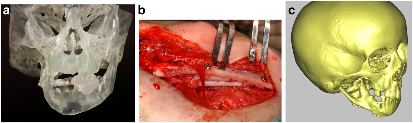 Figure 7: 
Construction of mandible with rib grafts. (a–c) A PK IIb case with long costo-chondral graft and further rib grafts to fill the defect with CT outcome.