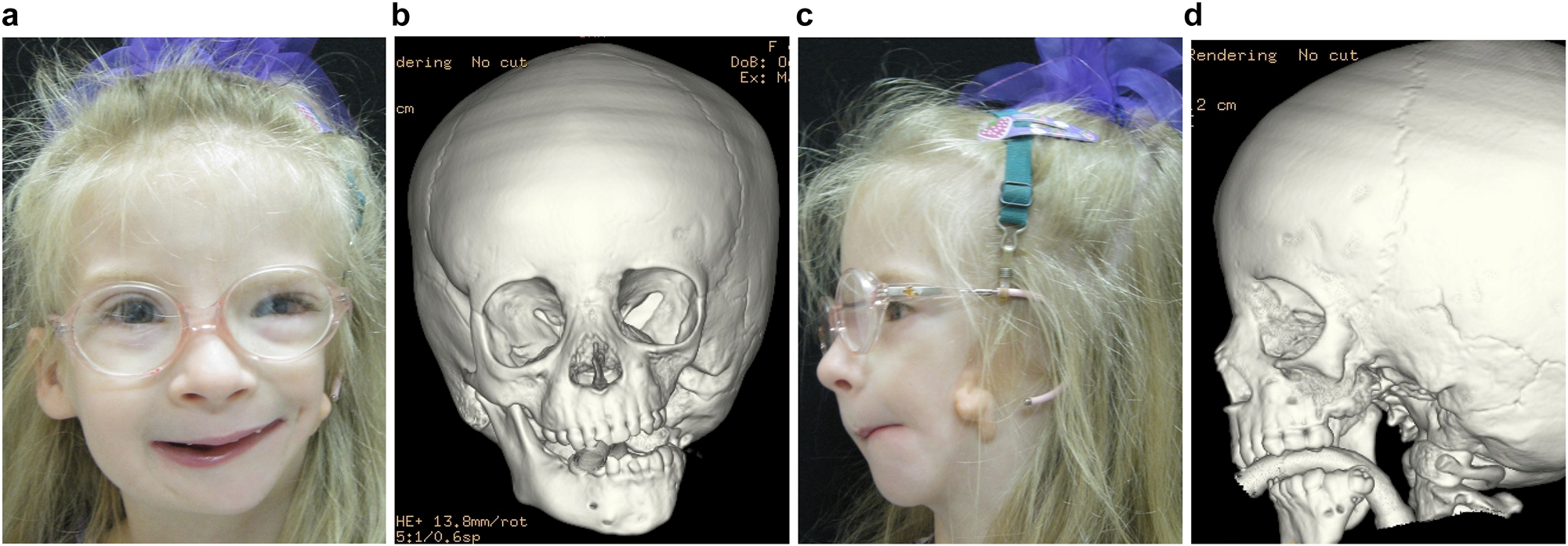 Figure 8: 
Construction of mandible with fibula free microvascular flap (a–d) 6 yr old girl with PK III HFM.