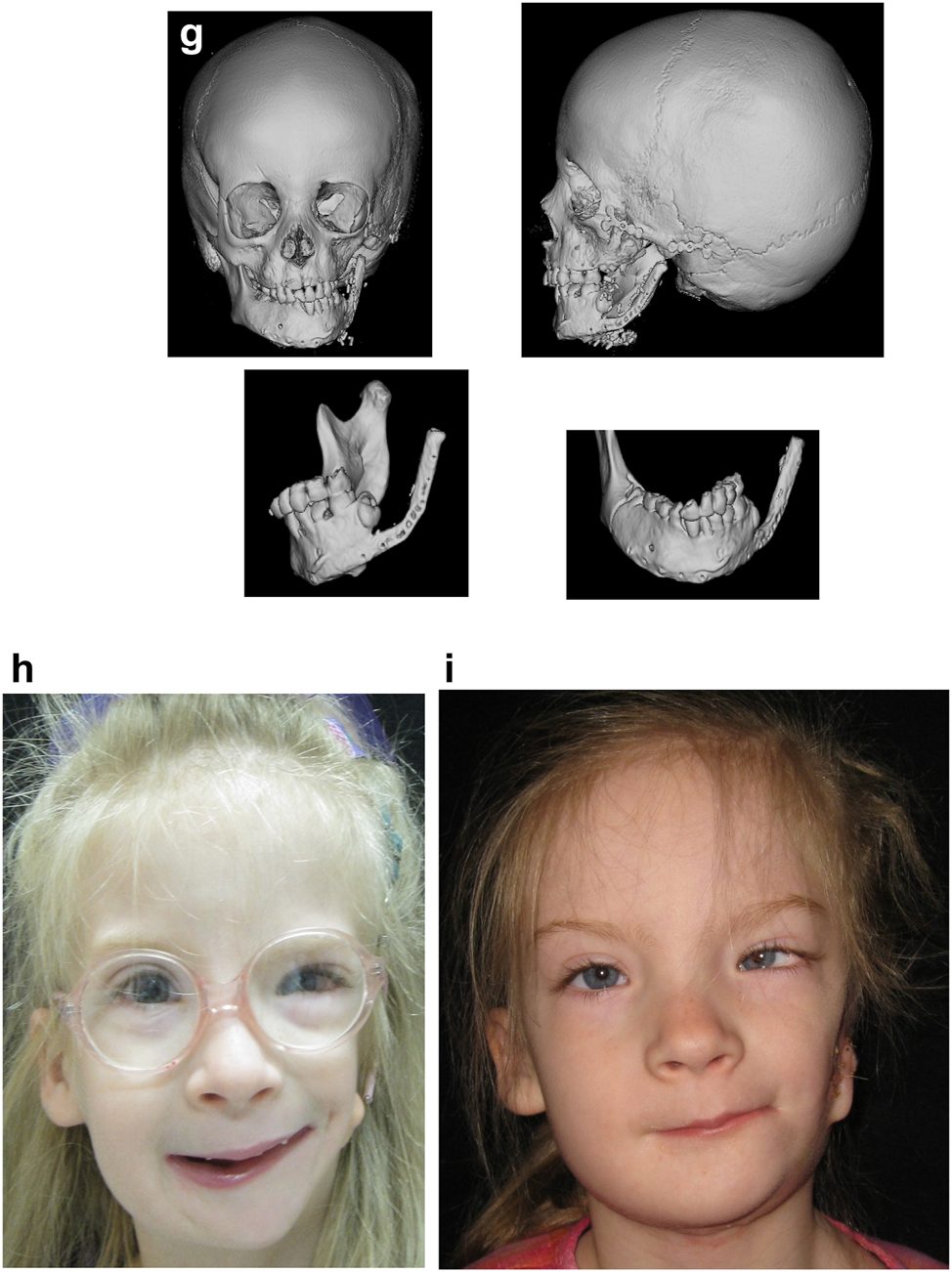 Figure 8: 
Construction of mandible with fibula free microvascular flap (g) 3D CT Outcome of the construction. (h) Pre-op. (i) Post-op.
