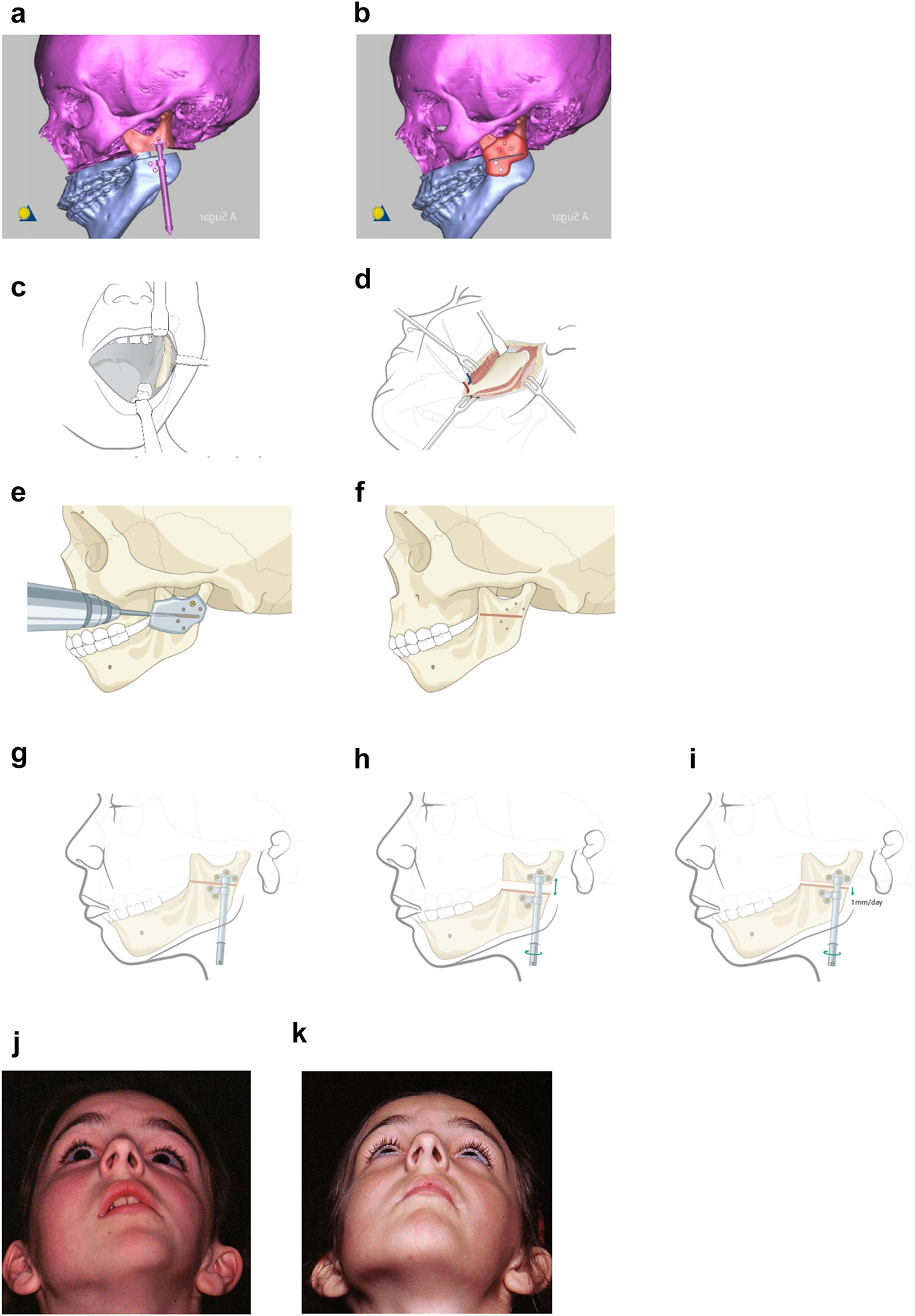 Figure 9: 
Planning for Distraction Osteogenesis (DO) to vertically lengthen the mandibular ramus. (a) A virtual distractor in position. (b) A virtual guide for this distraction which is 3D printed in metal before sterilisation. (c) An oral approach which is supplemented by trans-buccal instrumentation. (d) An external skin approach. (e) The guide is introduced and stabilised with a single screw. The holes for the distractor screws are drilled trans-buccally. The groove for the osteotomy is made with a reciprocating saw (for an external approach, an oscillating saw is used). (f) The guide has now been removed and the osteotomy cut is completed. (g) The distractor is inserted and fixed with screws. (h) The distractor is test-activated and then returned to its original position. (i) Distraction proceeds after a few days latency at 1 mm per day. (j) Pre-op. (k) After left vertical ramus distraction (same patient as Figure 1a and b).