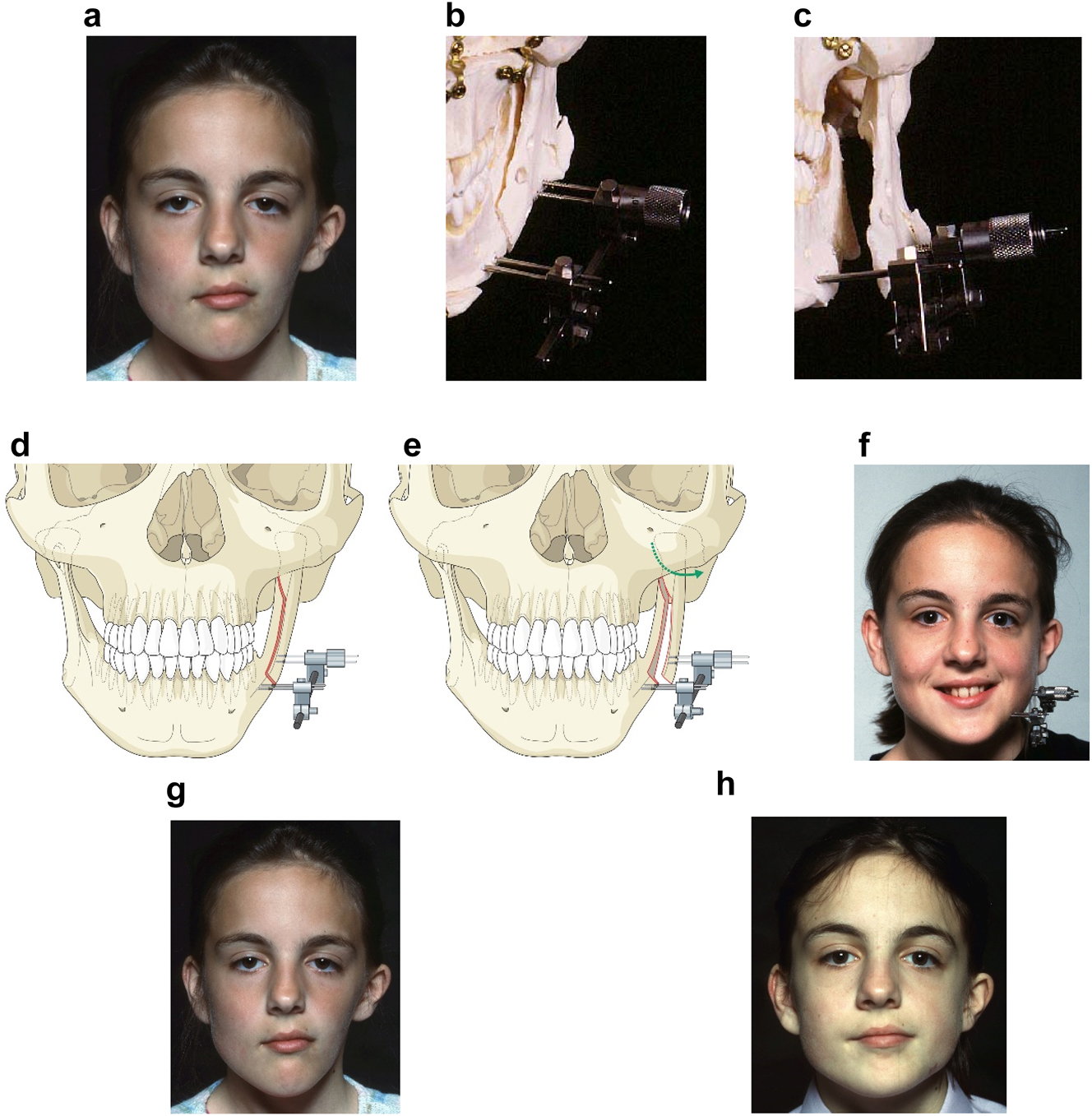 Figure 10: 
Planning for DO to broaden the mandibular ramus (same patient as Figure 9). (a) 1 year after left vertical DO. (b and c) Pins and distractor in situ on model with sagittal split osteotomy of left mandibular ramus with physical simulation of lateral DO. (d and e) Diagrammatic simulation of lateral distraction. (f) During lateral DO. (g) Post-vertical DO with lateral contour deficiency. (h) After both vertical and lateral DO.