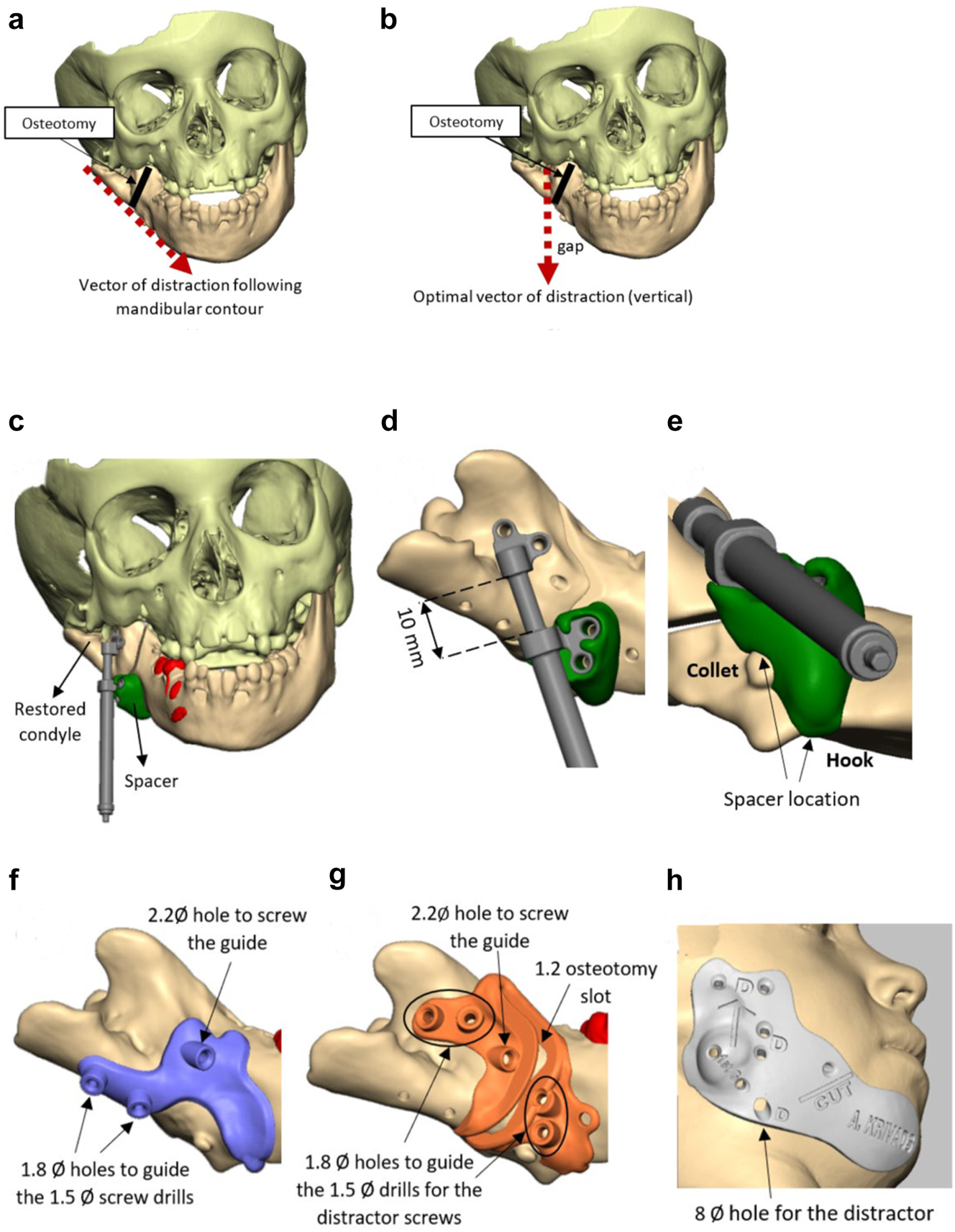 Figure 11: 
Planning for DO to vertically lengthen the mandibular ramus when the ramus is deficient laterally. (a and b) The vector problem in this reconstructed case. (c–e) The planned solution correcting the distraction vector to vertical with a spacer. (f–h) The virtual guides.