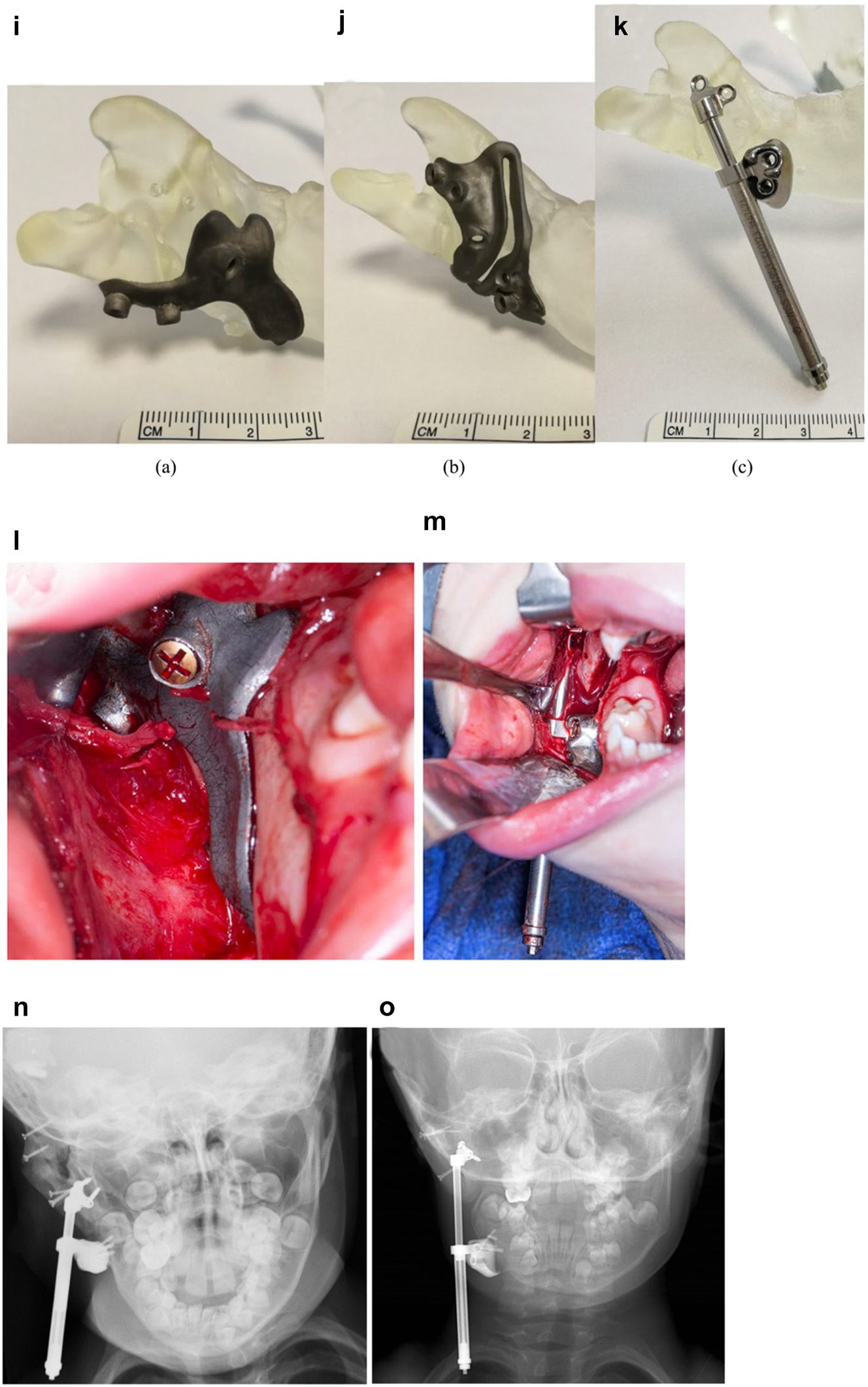 Figure 11: 
Planning for DO to vertically lengthen the mandibular ramus when the ramus is deficient laterally. (i–k) The 3D printed guides, spacer and distractor. (l and m) During surgery. (n and o) PA radiographs of the start and end points of distraction.