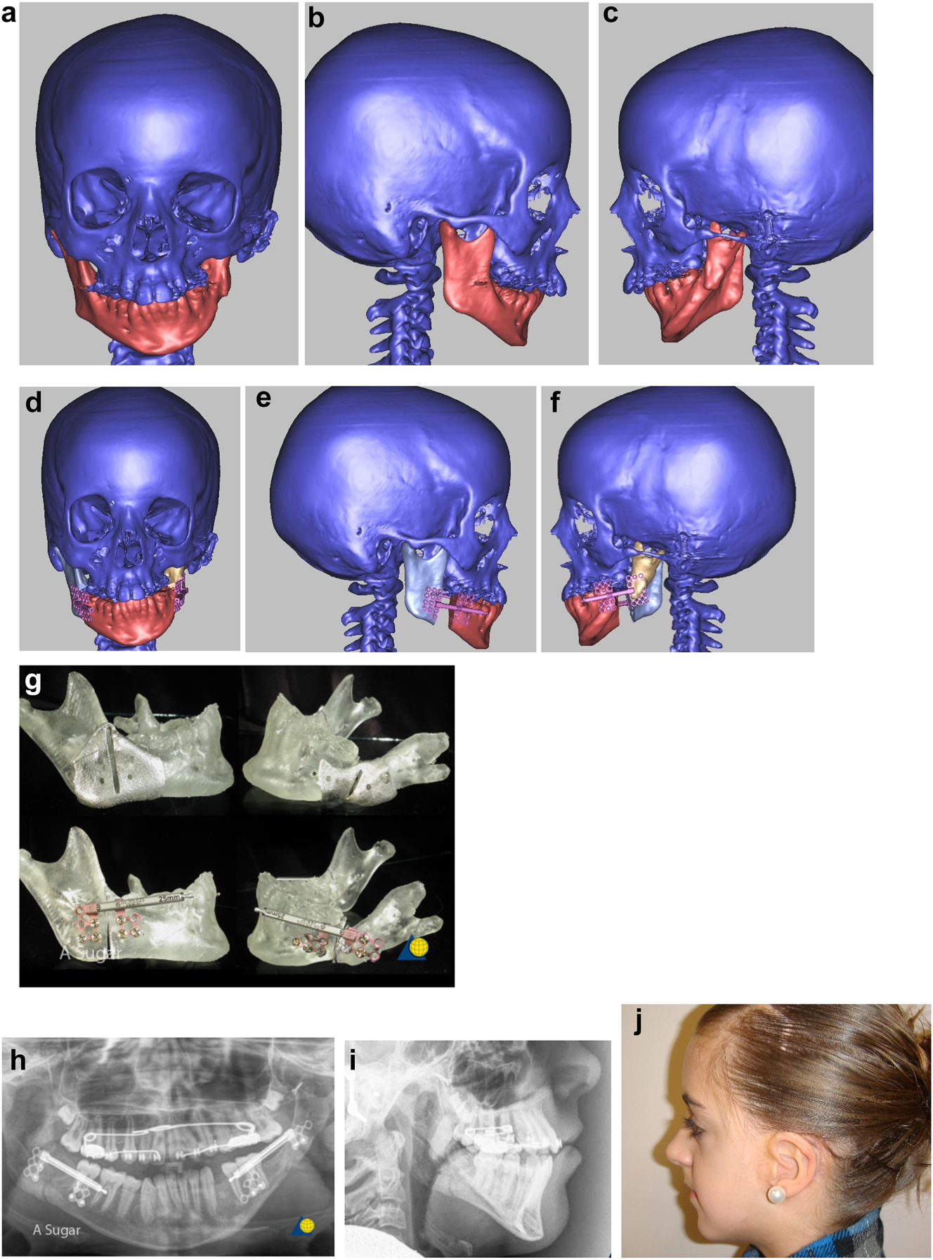 Figure 12: 
Planning for DO to advance the mandible horizontally. (a–c), (d–f) Virtual distractors in position and activated. From these, virtual guides were produced and 3D printed in metal (Figure 13g). (g) Actual guides and distractors on physical model. (h) End-point of distraction. (i and j) Outcome of bilateral mandibular body distraction – note left bone anchored ear prosthesis in situ.