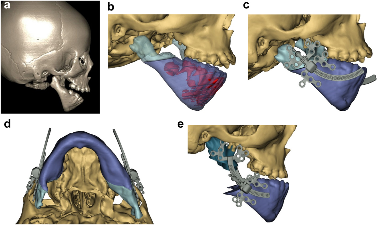 Figure 13: 
Planning for Curvilinear DO to lengthen the ramus vertically and to advance the mandible (a–e).