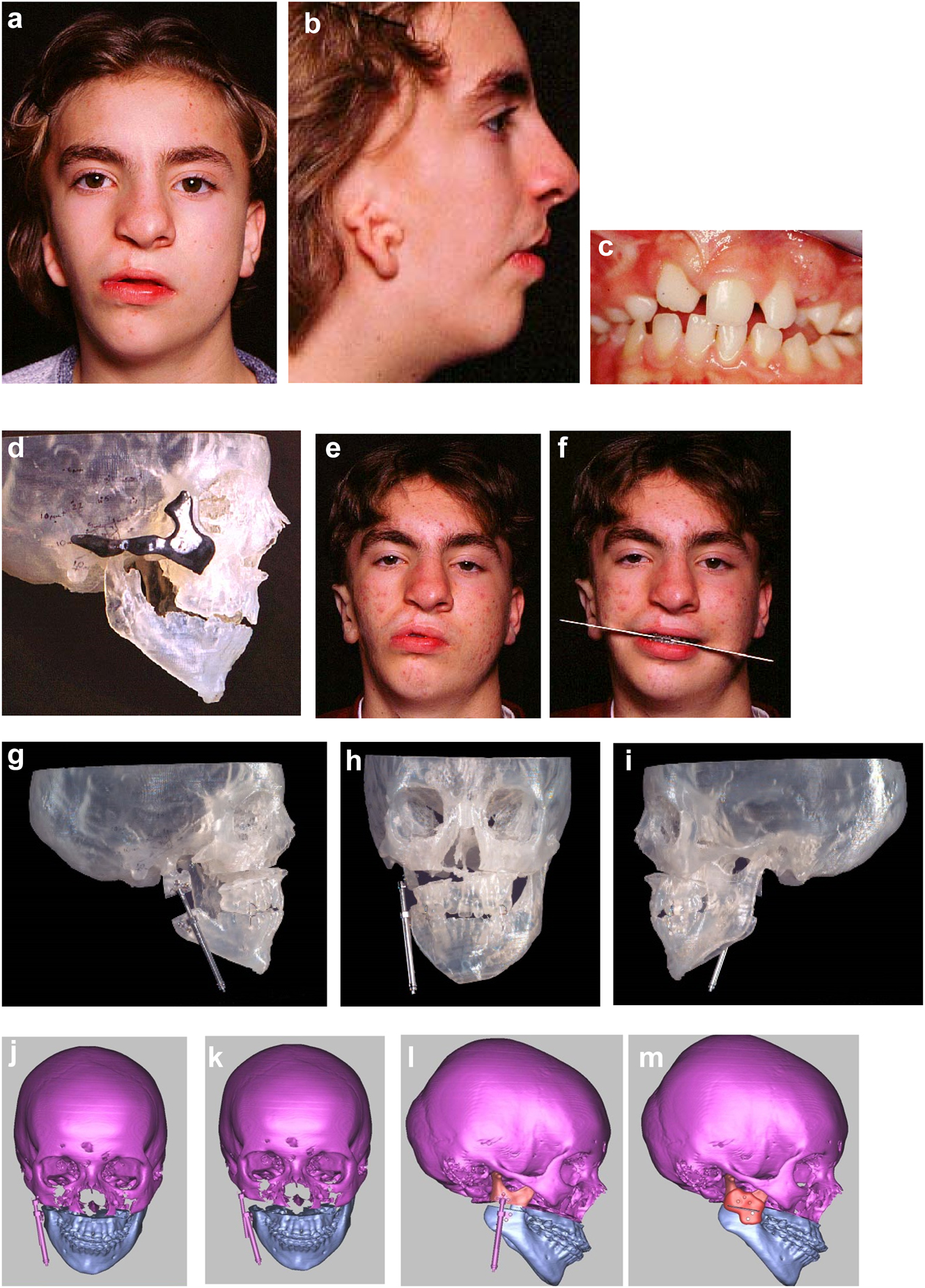 Figure 14: 
Planning for bimaxillary DO. (a–c) 12 year old male with PK IIa HFM and a repaired right sided UCLP. (d–f) Guide for zygomatic augmentation with rib graft and measurements for bone anchored ear prosthesis with outcome of both. (g–i) Plan on SLA model from CT scan. The maxillary attachment at the nasal septum is retained and the left maxilla rotates upwards during distraction for which bone needs to be removed. (j–m) Virtual bimaxillary distraction plan in another patient.