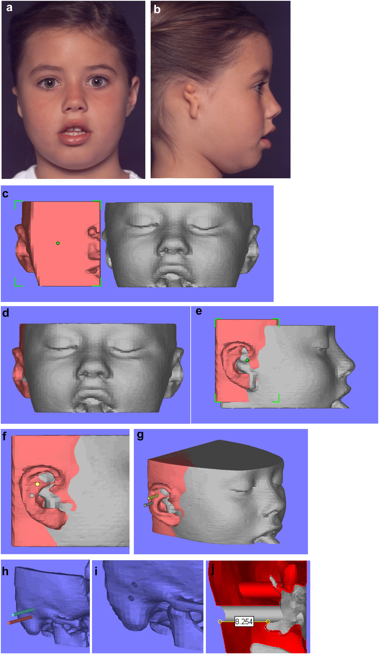 Figure 15: 
Planning for a child with microtia for a bone anchored ear prosthesis. (a and b) Right microtic ear. (c) CT scan of same patient imported into Mimics. Mirror image created (bone and soft-tissue) of left normal ear and surrounding structures and transferred to microtic side. (d and e) Mirror imaged ear moved until it matches the normal side in all dimensions. (f and g) Implants or cylinders are inserted in the appropriate sites. (h–j) The soft-tissues are then removed from the virtual image, the cylinders removed from the bone, and sections examined of the holes to ensure they have sufficient depth of good quality bone for implant insertion.