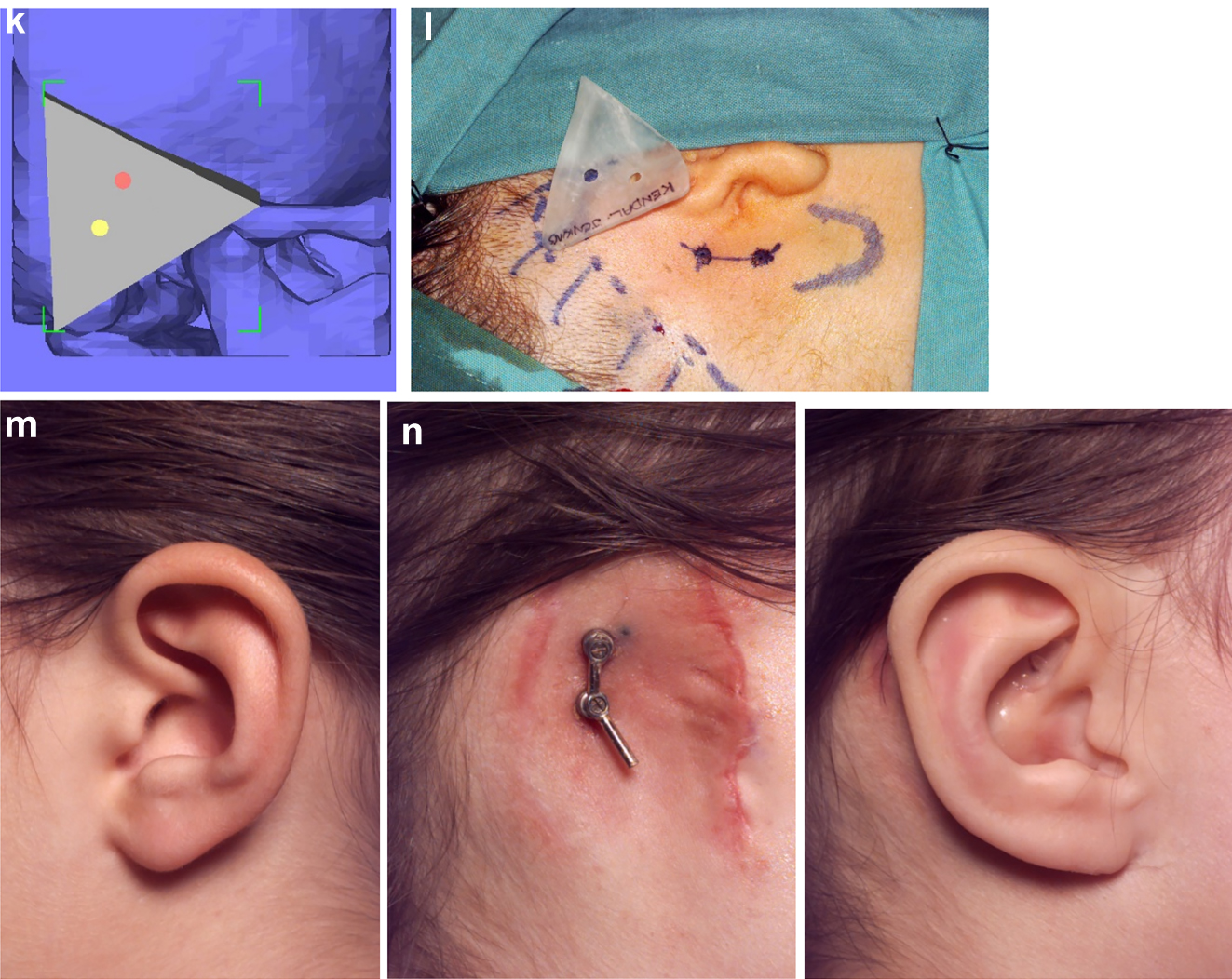 Figure 15: 
Planning for a child with microtia for a bone anchored ear prosthesis. (k and l) A virtual guide is then made (bone fitting or soft-tissue fitting) and then 3D printed as shown with the positions for the implants. (m and n) The clinical outcome, some ear cases are more challenging.