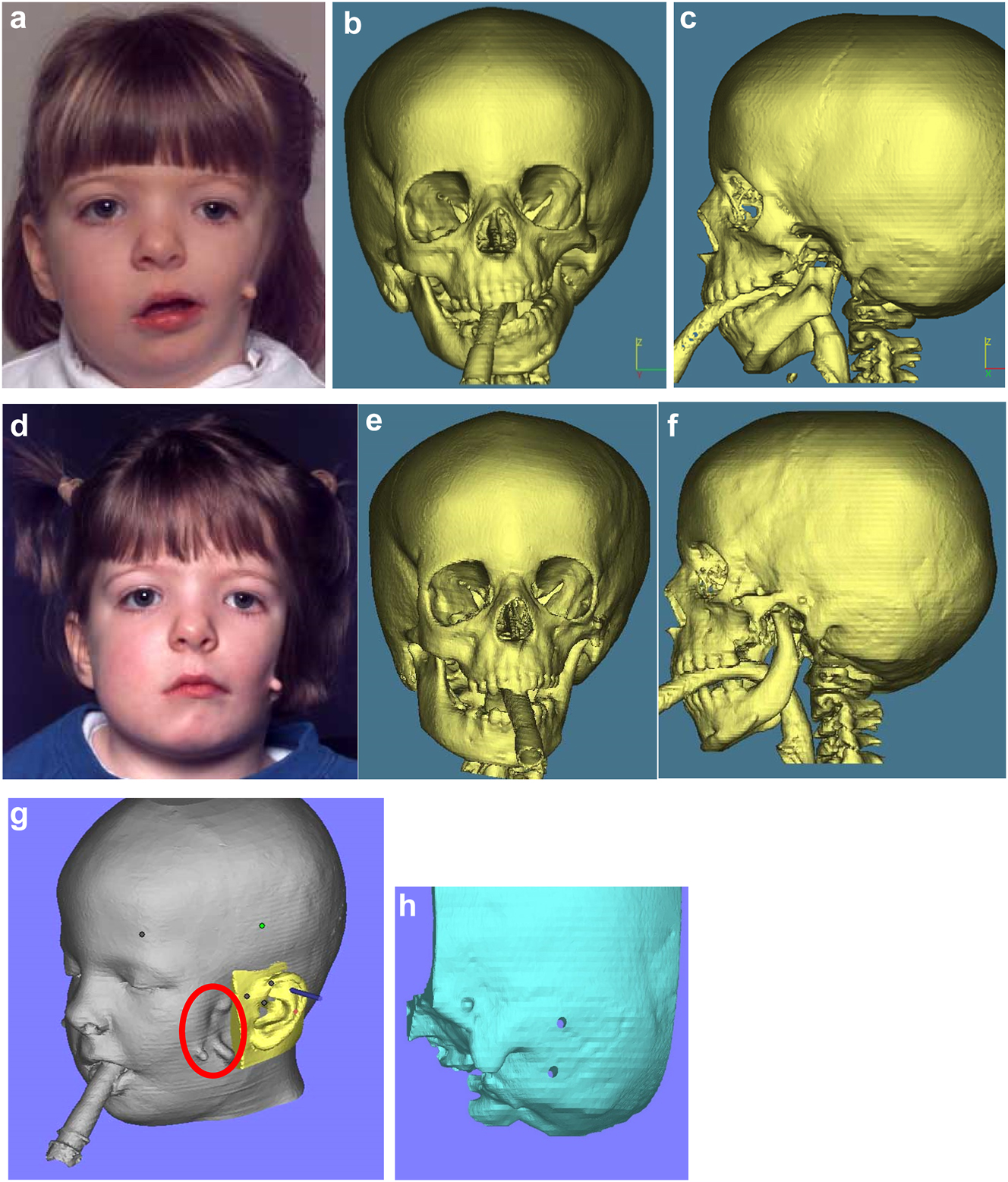 Figure 16: 
Construction of a PK III HFM child with a costo-chondral graft and then DO ramus lengthening followed by planning of a difficult bone anchored ear prosthesis with significant soft-tissue deficiency. (a–c) This young lady (Figure 16) presented aged 4 years with PK III HFM, severe scoliosis, an epi-bulbar dermoid cyst and severe microtia. She first underwent spinal fusion at 4 yrs of age, six months later construction of the left zygomatic arch and glenoid fossa, 6 months after a costo-chondral graft to construct the mandibular ramus and condyle and subsequently vertical distraction to lengthen the ramus. (d–f) Following the mandibular reconstruction and DO, g Virtual ear planning with soft-tissue Figure 17. (h) Note ideal sites for the ear/implants well posterior to the mastoid deficiency highlighted in red ellipse.