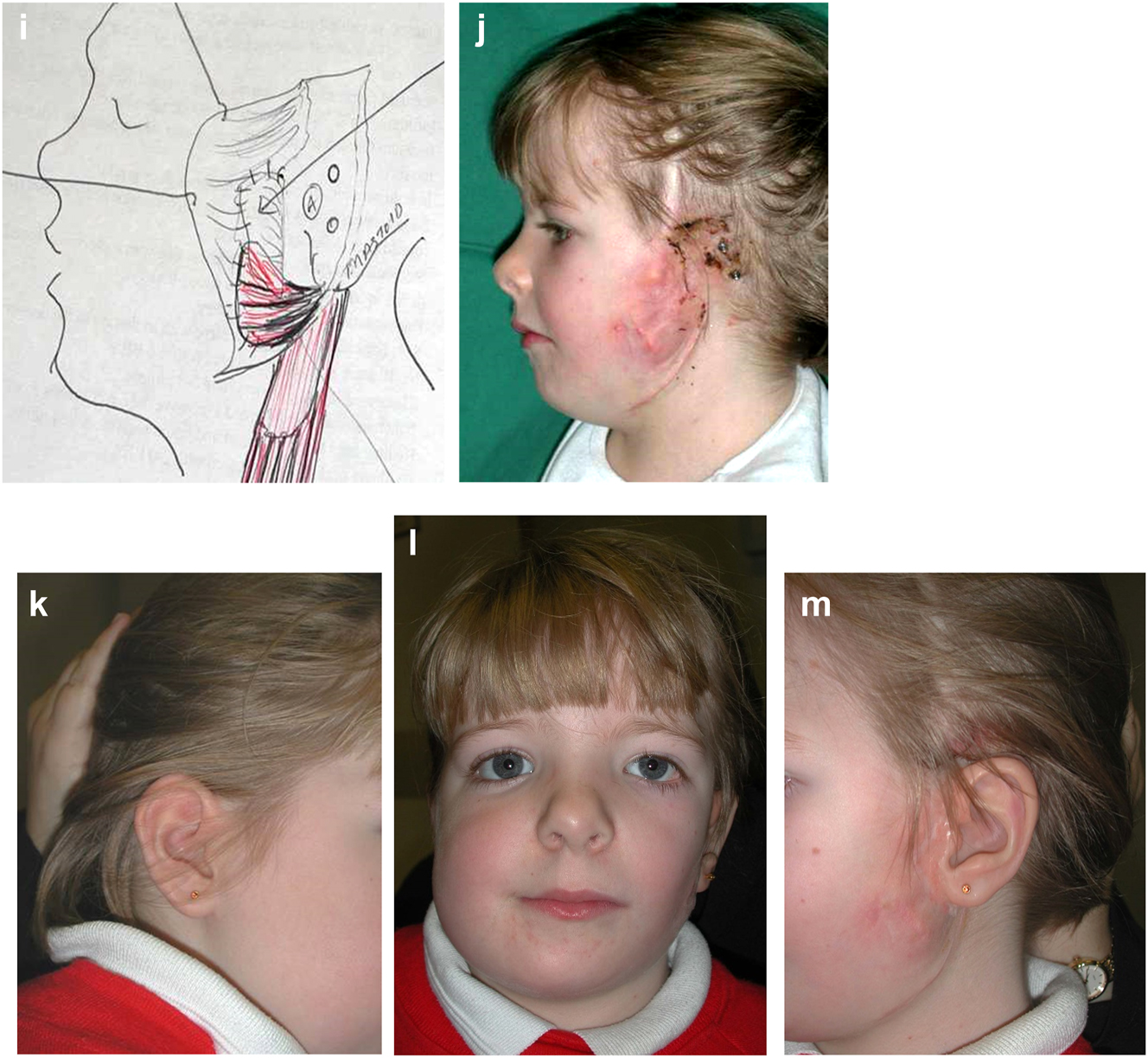 Figure 16: 
Construction of a PK III HFM child with a costo-chondral graft and then DO ramus lengthening followed by planning of a difficult bone anchored ear prosthesis with significant soft-tissue deficiency. (i and j) Note augmentation of the sub-cutaneous tissues anterior to the ear site by rotating upwards of a partial thickness flap of SCM muscle and rotating anteriorly a flap of subcutaneous tissue from around the implant sites. (k–m) The augmentation of the pre-auricular soft-tissues on the left enabled the prosthetist to construct a bone anchored ear prosthesis whose anterior margin was well disguised.