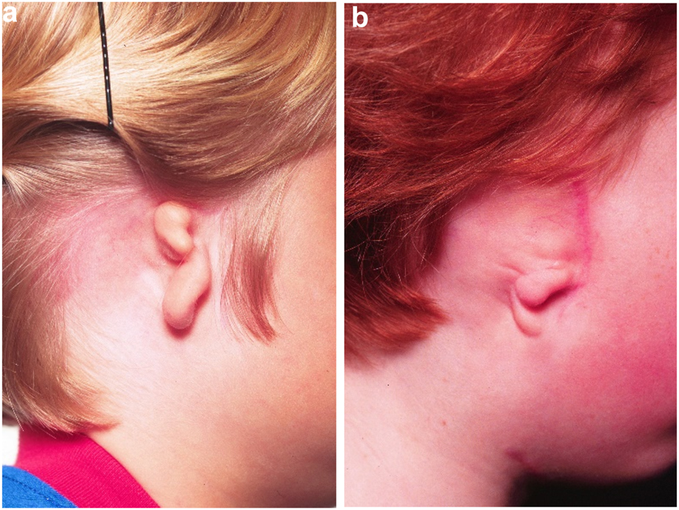 Figure 17: 
Microtia examples. (a and b) Typical microtic ears.