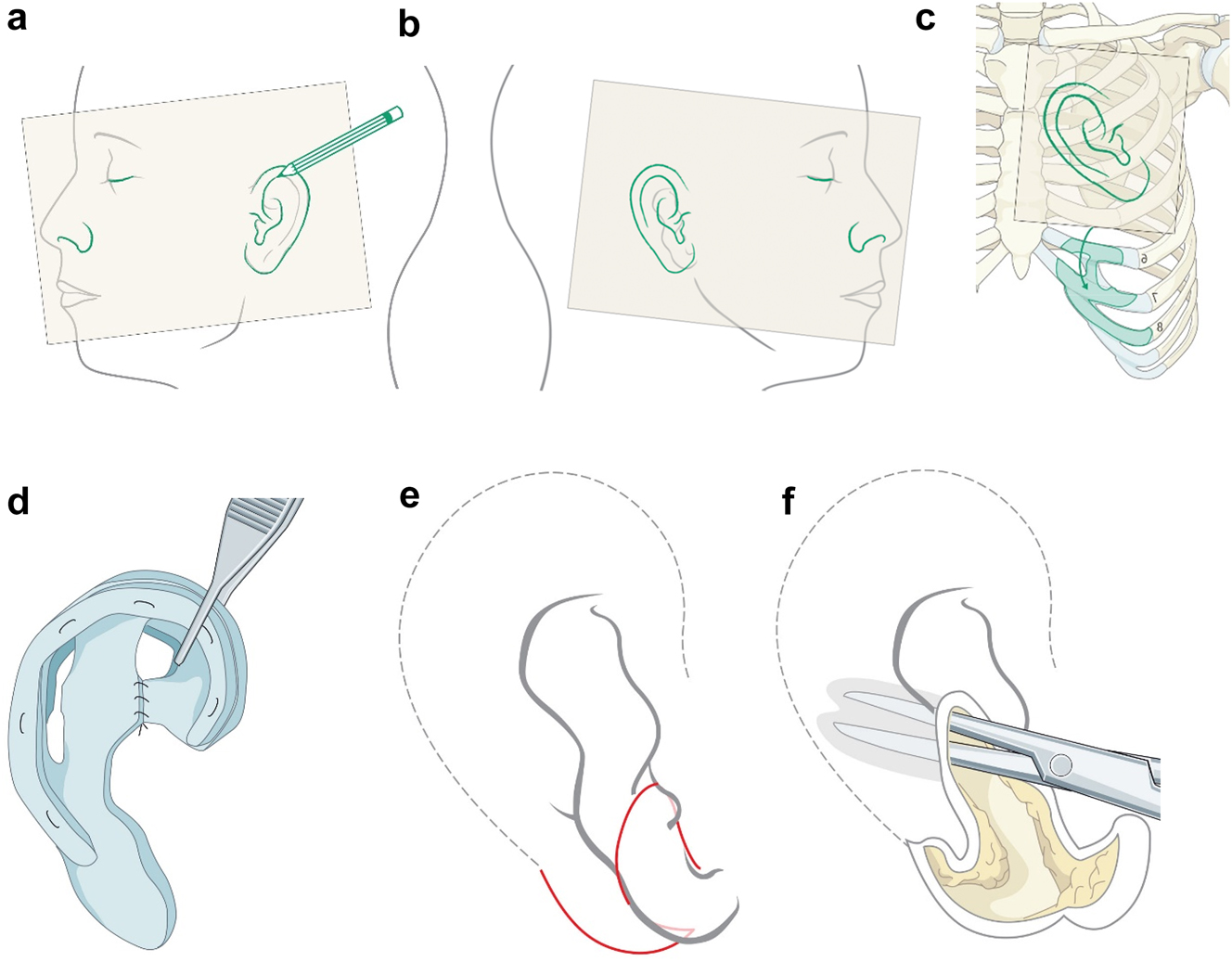Figure 18: 
Planning for autogenous ear construction (a–f).