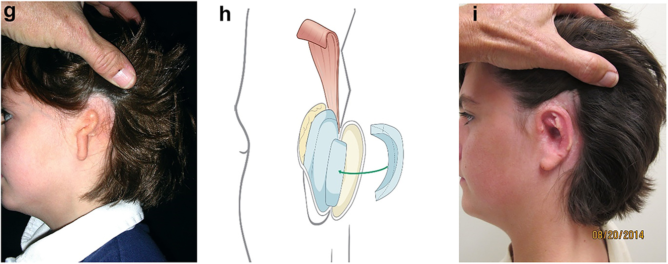 Figure 18: 
Planning for autogenous ear construction (g–i).