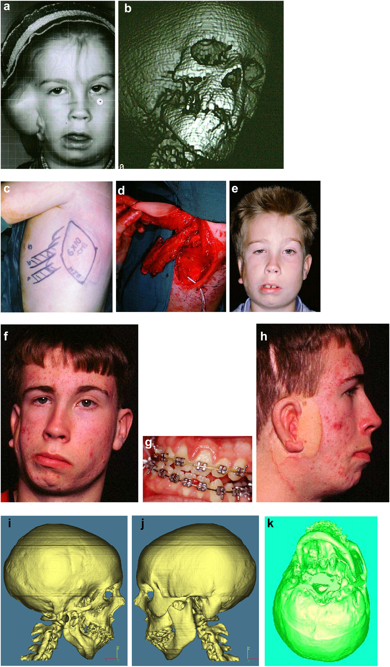 Figure 19: 
Planning for end stage reconstructrion with bimaxillary rotational osteotomies. (a and b) 8 yr old young man with PK III HFM and no zygomatic arch, glenoid fossa and mandibular condyle. Tissue expander in situ to produce sufficient soft tissue for ear construction. 3DCT scan at that age. (c–e) At 9 yrs of age, zygomatic arch, glenoid fossa and mand. condyle constructed with two vascularised ribs and serratus anterior muscle. (f–h) Same patient 9 years later showing established asymmetry. (i–k) Same patient’s 3D CT scan 9 years later. Significant asymmetry has developed again and pre-surgical orthodontics is completed.
