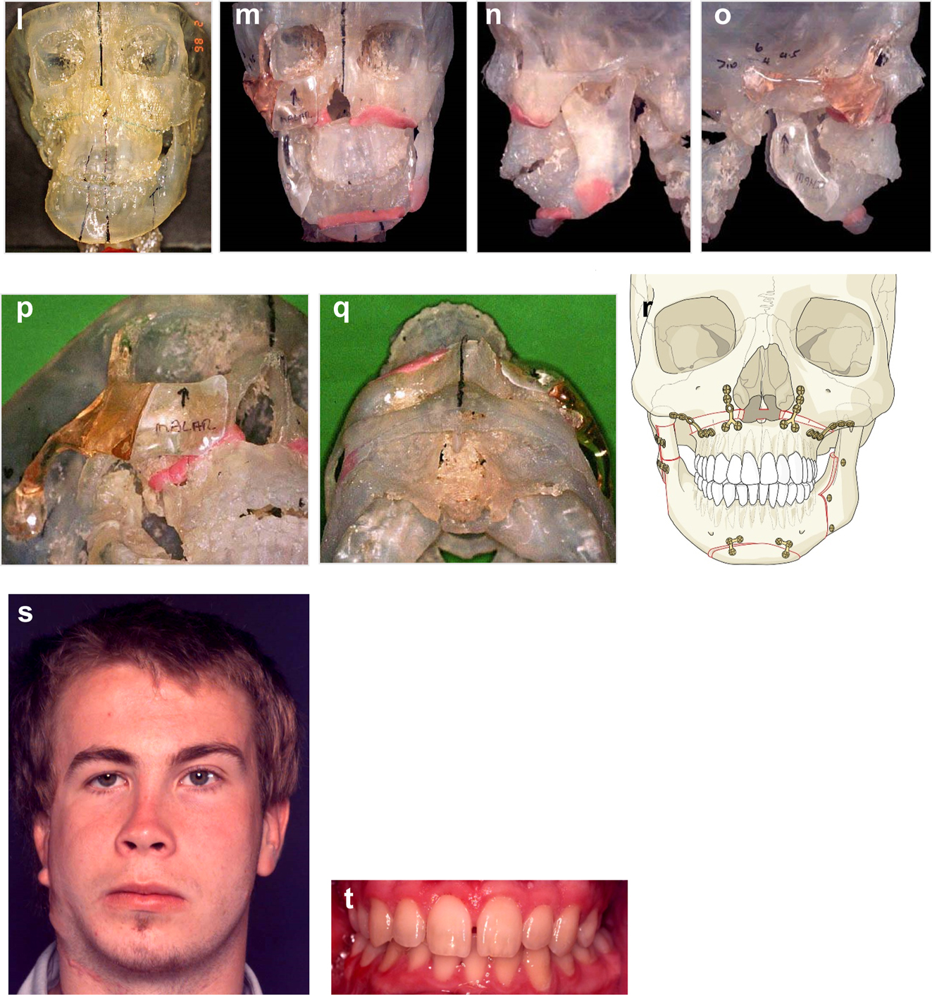 Figure 19: 
Planning for end stage reconstructrion with bimaxillary rotational osteotomies (l–t).