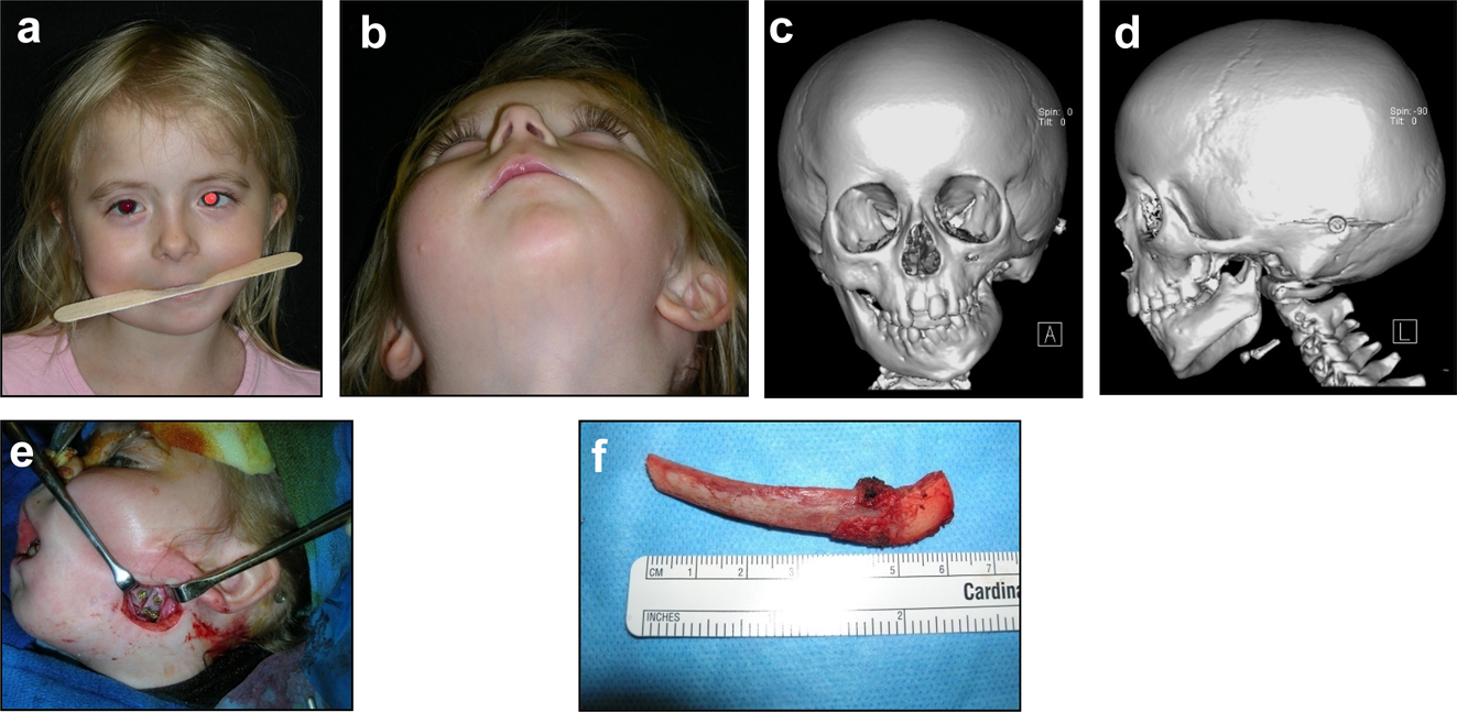 Figure 20: 
Construction of a HFM child with a costo-chondral graft followed by ramus lengthening by DO (a–f).