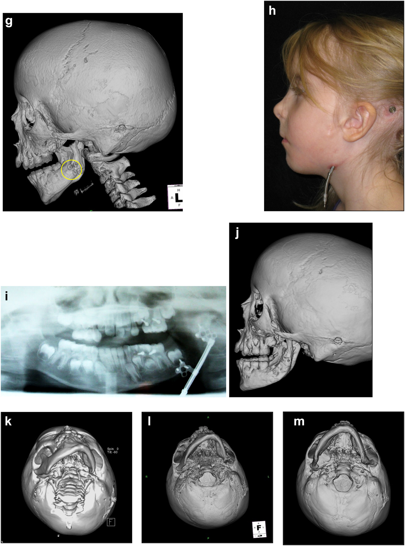 Figure 20: 
Construction of a HFM child with a costo-chondral graft followed by ramus lengthening by DO (g) Yellow ringed area is where the rib graft overlaps the original mandibular bone – the correct site for the DO osteotomy while avoiding any tooth germs. (h) Percutanous distractor port in situ. (i), (j), (k–m) Submental view of mandibular shape and position pre rib graft (k), post rib graft (l), post distraction (m).