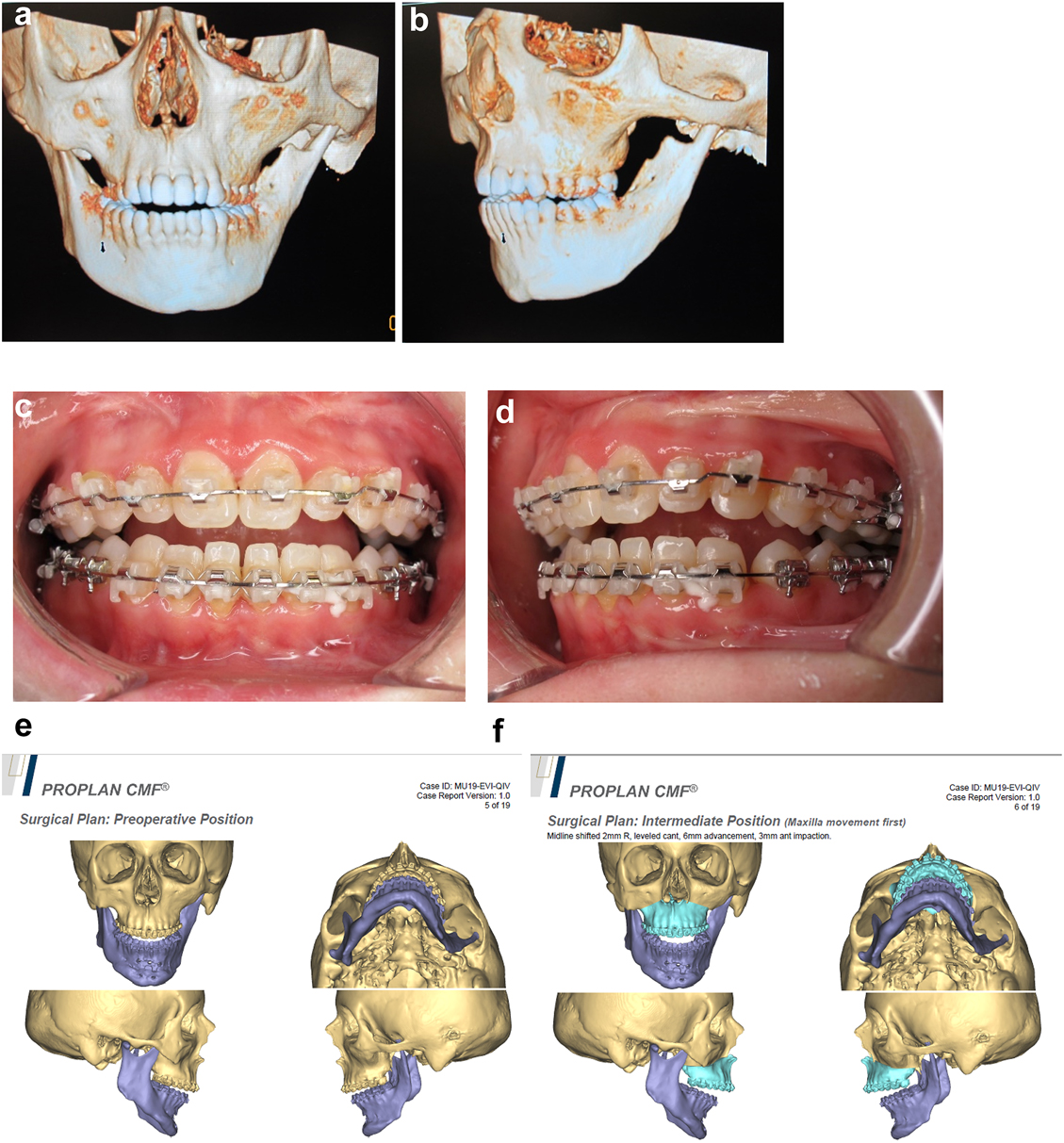 Figure 21: 
Planning of end stage reconstruction (same patient as Figure 20) by orthodontics and bimaxillary rotational osteotomies. (a and b) Same patient as Figure 20 at 15 yrs of age. (c–f) 3D pre-op and plans for the maxillary osteotomy.