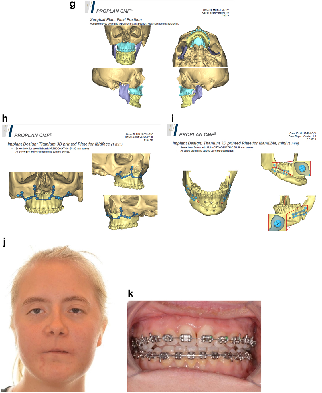 Figure 21: 
Planning of end stage reconstruction (same patient as Figure 20) by orthodontics and bimaxillary rotational osteotomies. (g) Plans for the bimax osteotomies. (h and i) Plans for printing of 3D plates for fixation of maxilla and mandible osteotomies, (j and k) Clinical outcome.