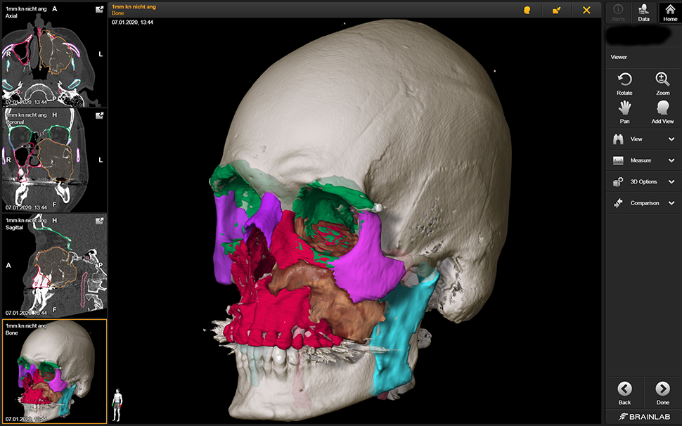 Figure 2: 
Segmentation of an invasive squamous cell carcinoma (brown) of the left maxillary sinus and adjacent structures (red – maxilla, green – orbit, pink – zygomatic bone, purple – nasal bone and contralateral zygomatic bone).