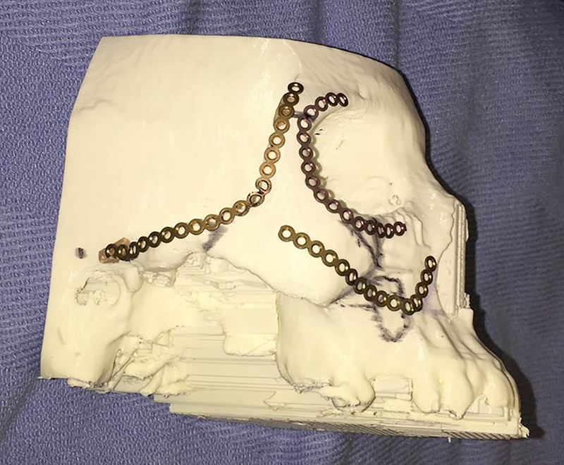 Figure 7: 
3D model used for template bending in the preoperative setting.