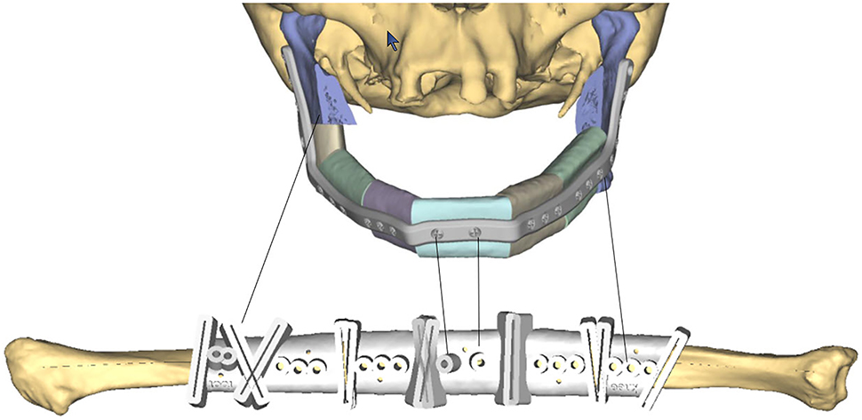 Figure 8: 
3D printed cutting guide for mandible reconstruction.