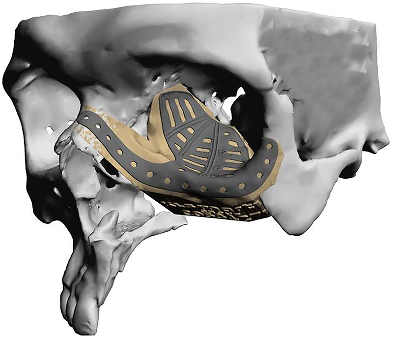 Figure 9: 
Commercially fabricated patient specific implant for orbito-midface reconstruction.