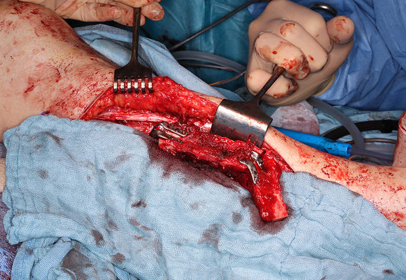 Figure 10: 
Patient specific implant used to shape fibula in situ for mandibular reconstruction.