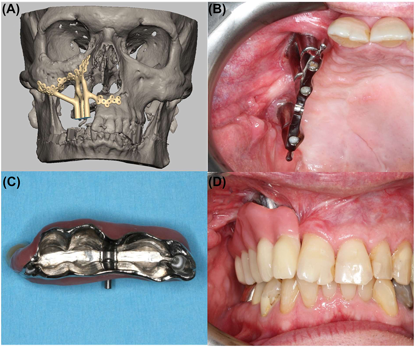 Figure 7:
Digital planning (A) and postoperative result two years after insertion of the patient-specific implant with bar superstructure (B) and final prosthesis (C) as well as integrated dentures (D).
