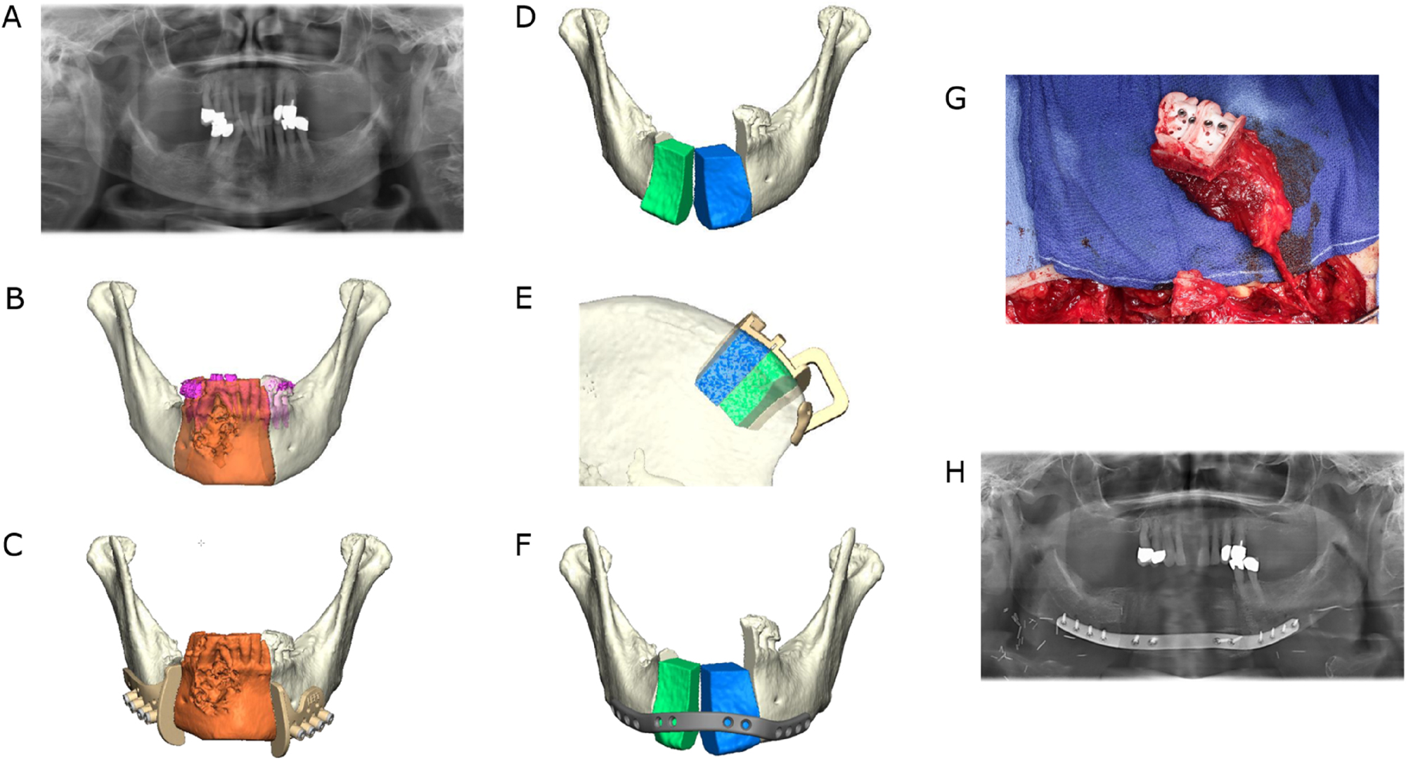 Figure 3:
Ameloblastoma of the right symphyseal and body region. Mandibular resection and reconstruction with a microvascular bone flap from the iliac crest is planned. (A) Preoperative panoramic radiograph. (B) Virtual model depiction of the resection area (orange). (C) CAD with combined osteotomy/predrilling guides. (D) Planned reconstruction with ilia crest segments after opening-wedge osteotomy (the gap is later filled with cancellous bone). (E) CAD with osteotomy guide for harvesting the iliac crest transplant. (F) CAD with a patient-specific implant (PSI). (G) Harvested iliac crest flap with osteotomy guide still attached to the vascular pedicle (deep circumflex iliac artery, DCIA). (H) Postoperative panoramic radiograph.