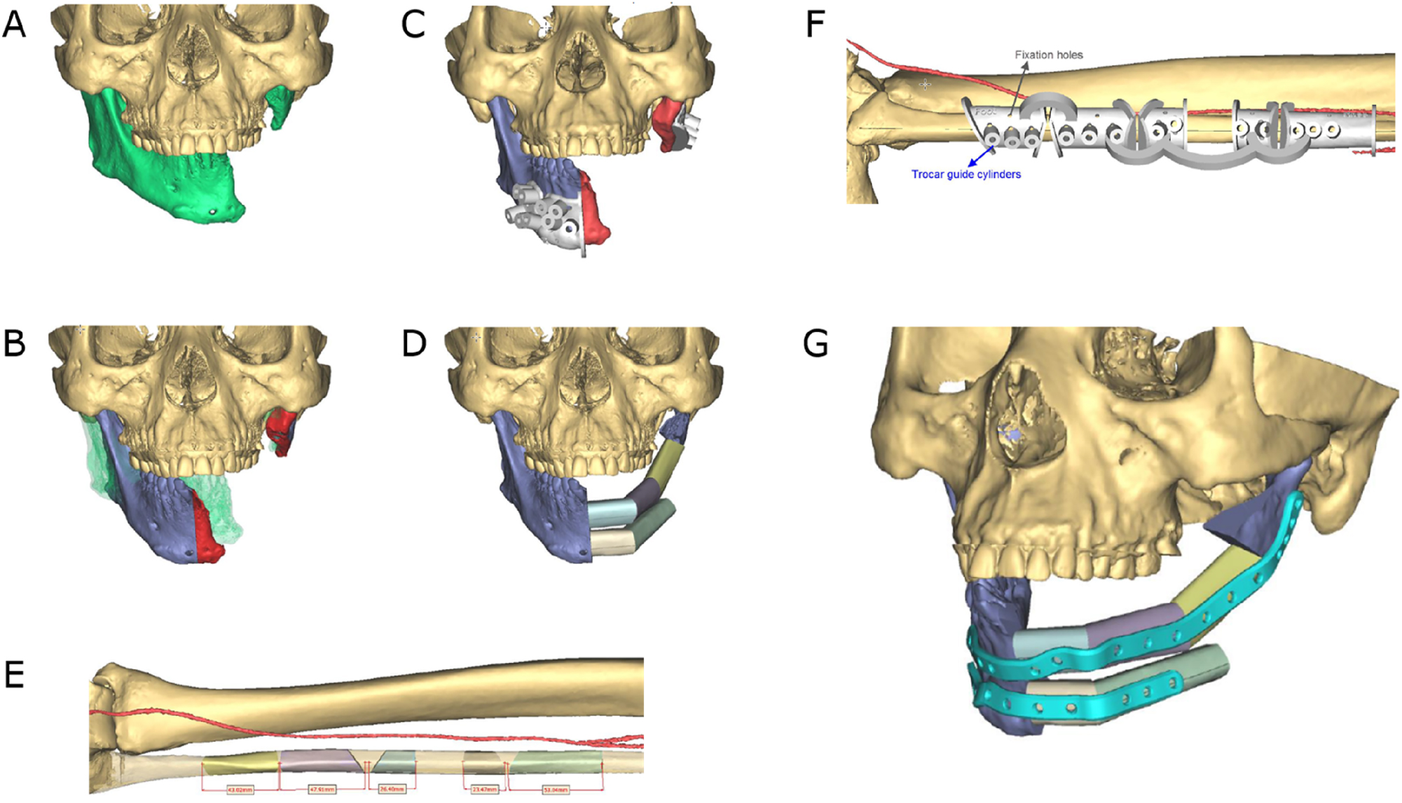 Figure 4:
Secondary mandible reconstruction with a double-barrel fibula bone flap and a patient-specific plate (PSI). (A) Virtual 3D model showing the defect area and deviation of the remaining mandible part. (B) Virtual repositioning of the mandible and depiction of the resection area (red). (C) CAD of combined osteotomy/predrilling guides. (D) Planned reconstruction with double-barrel fibula bone flap. (E) Five fibula bone segments are planned. (F) CAD of osteotomy guide for harvesting and segmentation of the fibula bone flap. (F) CAD of a patient-specific implant (PSI).