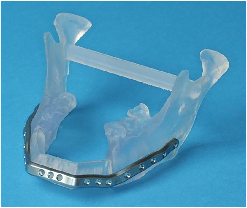 Figure 5:
Transparent acrylic STL model including the remaining mandibular elements and the neomandible in the symphyseal area in a case where mandibular resection and reconstruction with a microvascular scapular bone flap is planned.