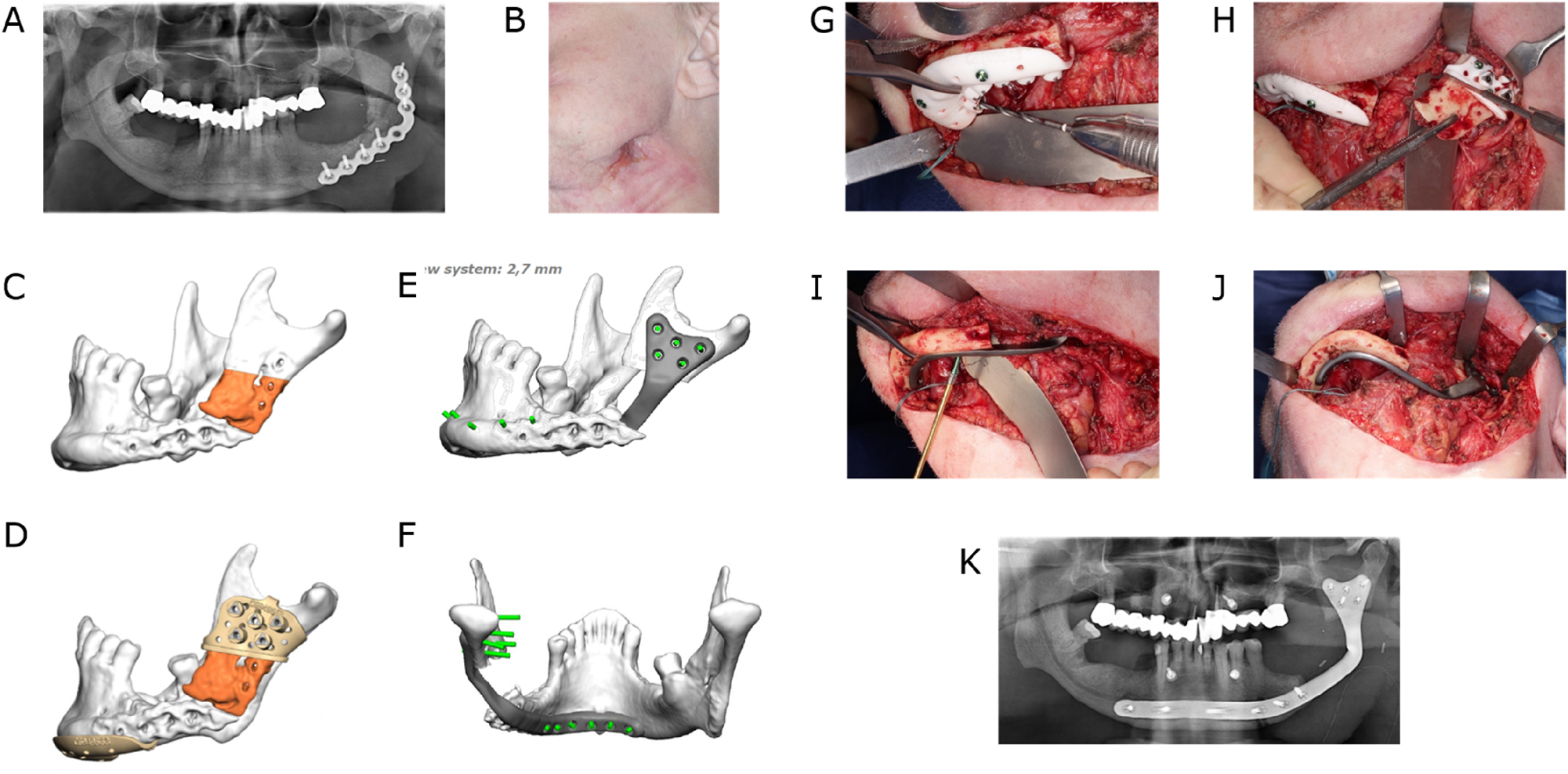 Figure 6:
Lingual application of a patient-specific mandible reconstruction plate. (A) Panoramic radiograph of a patient with antiresorptive drug-induced osteonecrosis of the jaw (ARONJ) in the ramus and body region left and a fractured reconstruction plate and (B) compromised soft tissue with cutaneous fistula. (C) Virtual model depiction of the resection area (orange). (D) CAD of combined osteotomy/predrilling guides. (E) and (F) CAD of a patient-specific implant (PSI). (G) Predrilling at the symphyseal area. (H) Resection at the ramus area. (I) Fixation of lingual positioned PSI at the symphyseal area. (J) PSI attached to the mandible. (K) Postoperative panoramic radiograph.