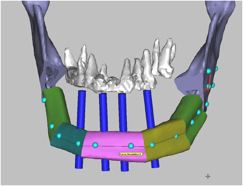 Figure 7:
Virtual surgical planning (VSP) for mandibular reconstruction with a fibula bone flap. Four blue dental implant dummies indicate the correct position of the fibula bone segments in relation to the maxillary teeth in order to facilitate the later insertion of dental implants as part of the dental rehabilitation.