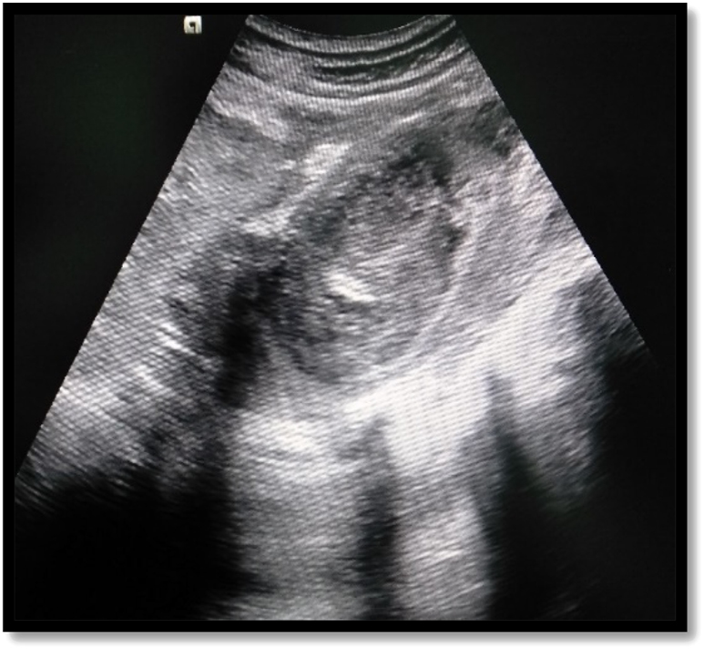 Figure 1:
Ultrasonographic image shows heteroechoic collection in the psoas muscle.