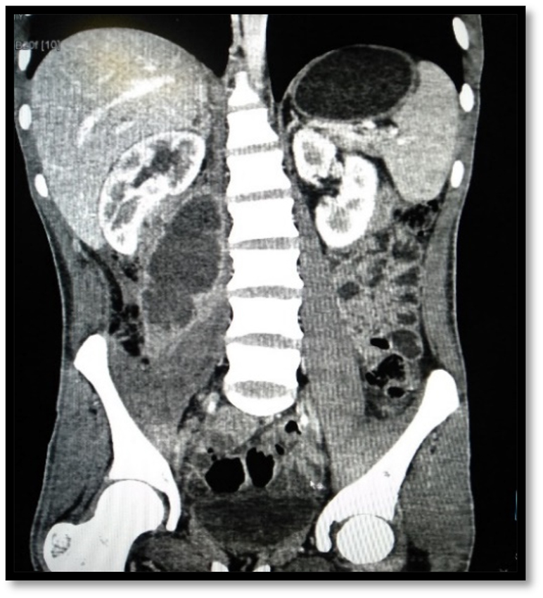 Figure 2:
Coronal CT scan images of the abdomen and pelvis shows right sided iliopsoas abscess.