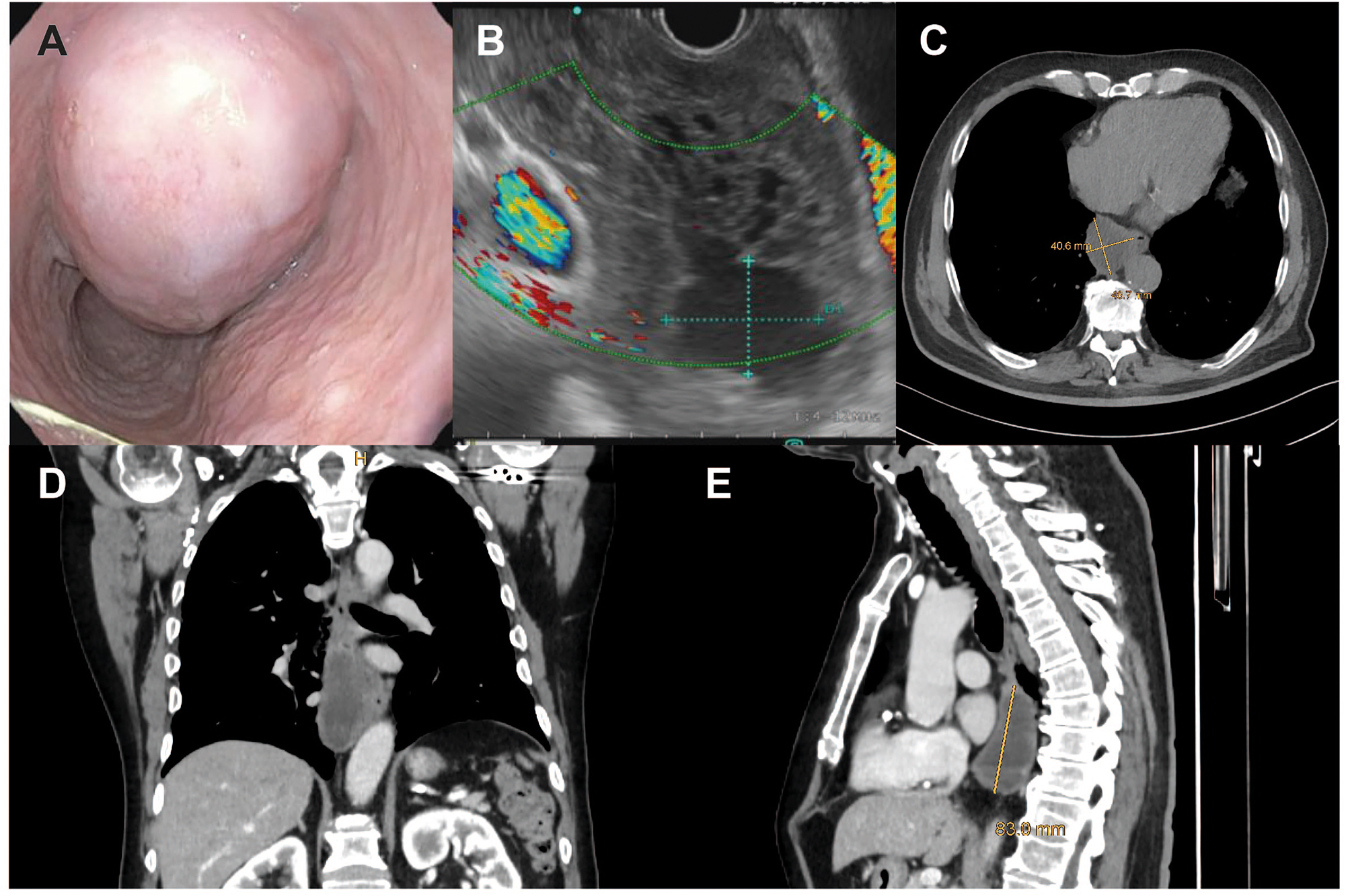 Figure 1: 
Case of a male patient with a large (9 × 5 cm) esophageal GIST. Endoscopic (A) and endosonographic (B) view, as well as transverse (C), coronal (D) and sagittal (E) computed tomography planes of the tumor.

