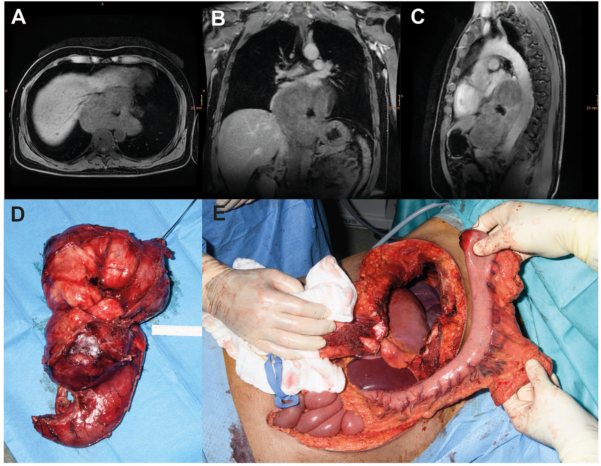 Figure 3: 
Case of a male patient with a giant (17 × 14 × 8 cm) esophageal leiomyoma with abscess following diagnostic biopsy. Transverse (A), coronal (B) and sagittal (C) magnetic resonance imaging planes of the tumor. (D) Intraoperative images of the resected specimen and (E) the situs after thoraco-laparotomy before reconstruction with interposition of the tubulized stomach.
