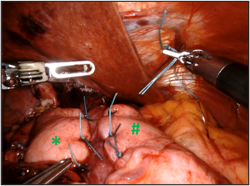 Figure 4: 
Toupet fundoplication with a 3–4 cm gastric wrap around 270° of the esophagus is obtained by fixing left (#) and right part (*) of the fundus to anterior muscular part of the esophagus with interrupted nonabsorbable sutures.
