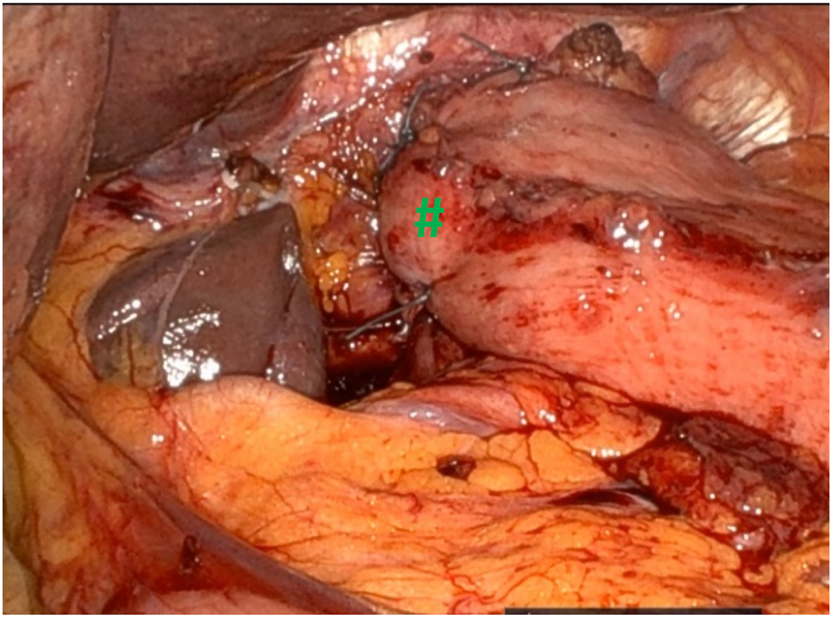 Figure 5: 
Dor fundoplication with a partial 180° wrapping of the gastric fundus (#) around the esophagus is performed as an alternative to Toupet fundoplication.

