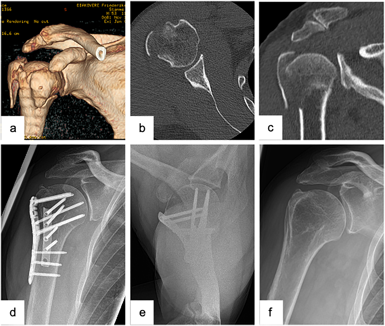 Figure 2: 
Male patient (53 y), right shoulder, valgus impacted 4-part proximal humerus fracture (preoperative (3D-) CT-scan: a – 3D-CT-reconstruction, b – axial, c – coronal), open reduction and internal fixation with a laterally positioned locking plate osteosynthesis and a second, supportive, ventrally positioned plate to stabilize the lesser tuberosity (postoperative X-ray: d – a.p., e − Y-plane), complete removal of the double plate osteosynthesis and arthroscopically assisted arthrolysis (postoperative X-ray: f – a.p.).
