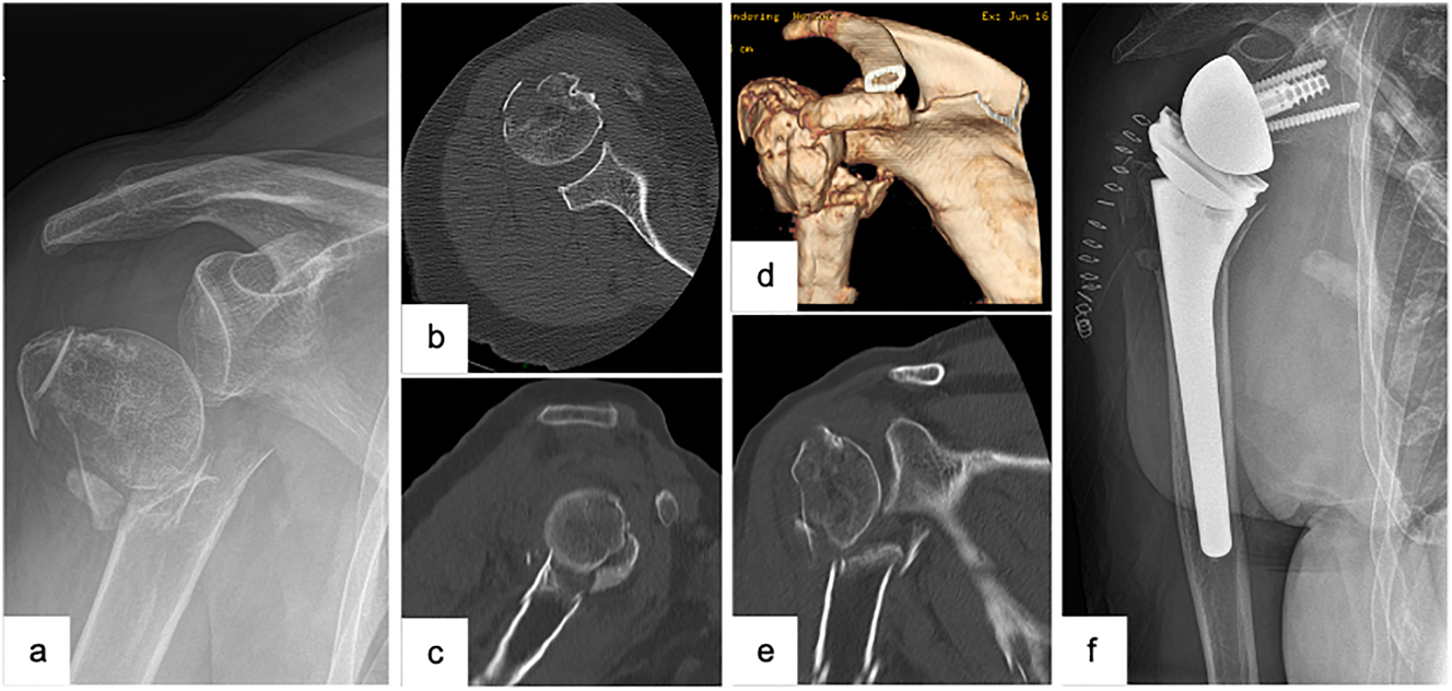 Figure 3: 
Female patient (83 y), right shoulder, varus distracted 4-part proximal humerus fracture (preoperative X-ray and (3D-) CT-scan: a – a.p., b – axial, c – sagittal, d – 3D-CT-reconstruction, e – coronal), implantation of a reverse total shoulder arthroplasty (postoperative X-ray: f – a.p.).
