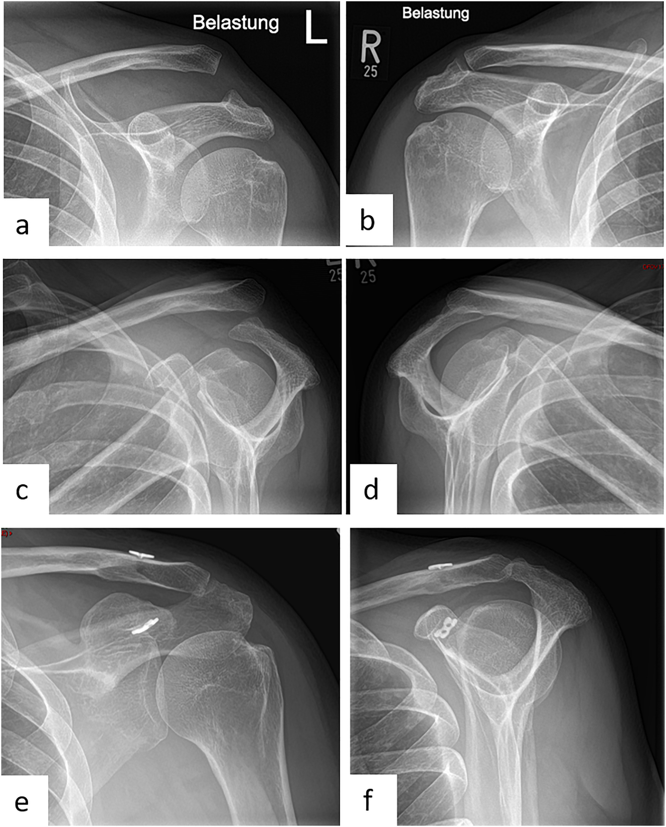 Figure 4: 
Female patient (50 y), left shoulder, acute acromioclavicular joint dislocation (Rockwood 5) (preoperative X-ray): a – Zanca stress radiographs with 10 kg weights left shoulder, b – Zanca stress radiographs with 10 kg weights right shoulder, c – Alexander radiograph left shoulder, d – Alexander radiograph right shoulder, arthroscopically supported vertical and horizontal stabilization with a TightRope, postoperative X-ray: e – Zanca, f – Outlet view.

