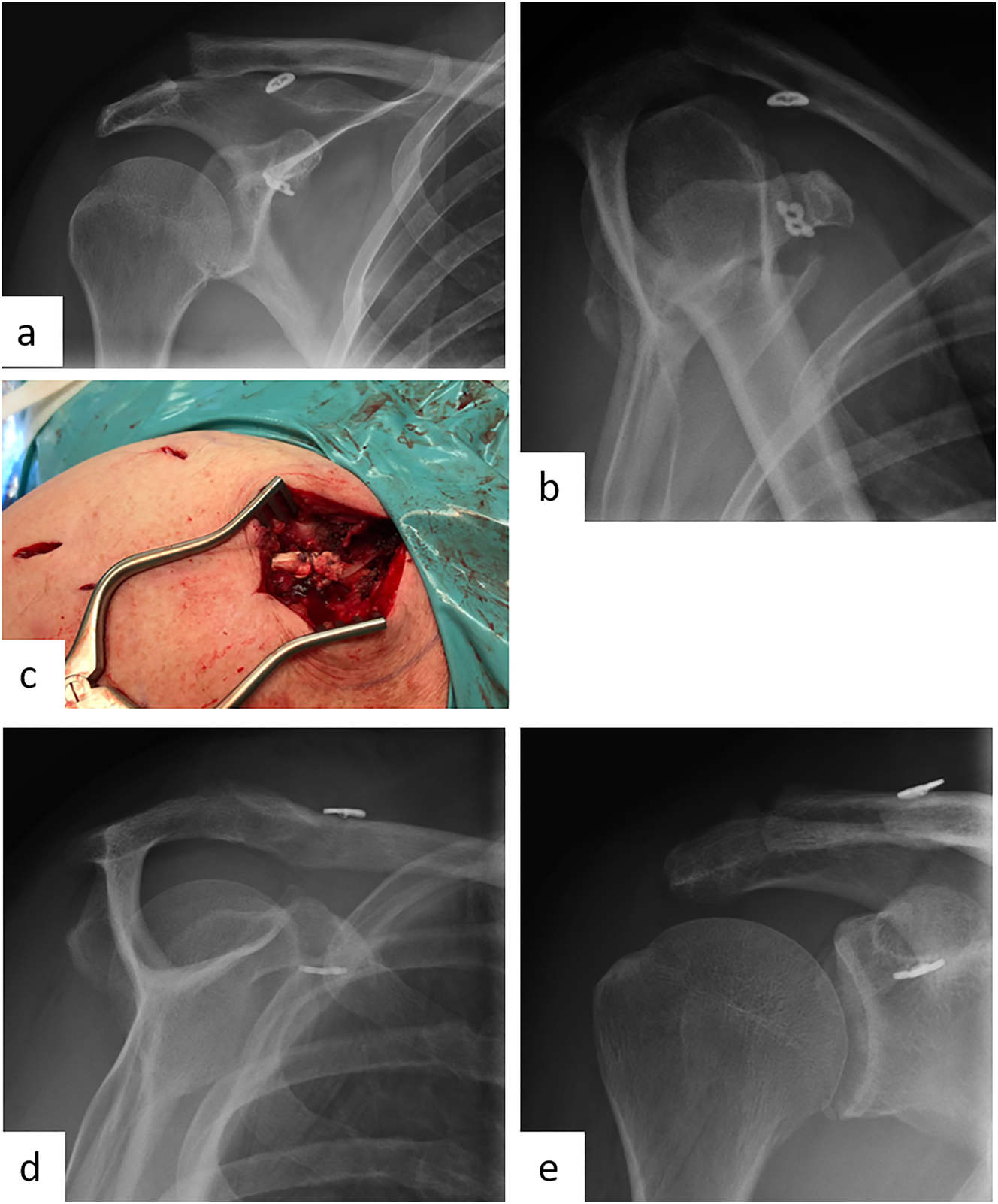 Figure 5: 
Male patient (55 y), right shoulder, chronic acromioclavicular joint instability with loss of reduction after surgical displacement of an acute Rockwood 3B injury 3 months ago (preoperative X-ray): a – Zanca stress radiograph with 10 kg weight, b – Alexander radiograph, c – arthroscopically supported vertical and horizontal stabilization with a TightRope and an additional autologous Hamstring-tendon augmentation, postoperative X-ray: d – Outlet view, e – a.p.

