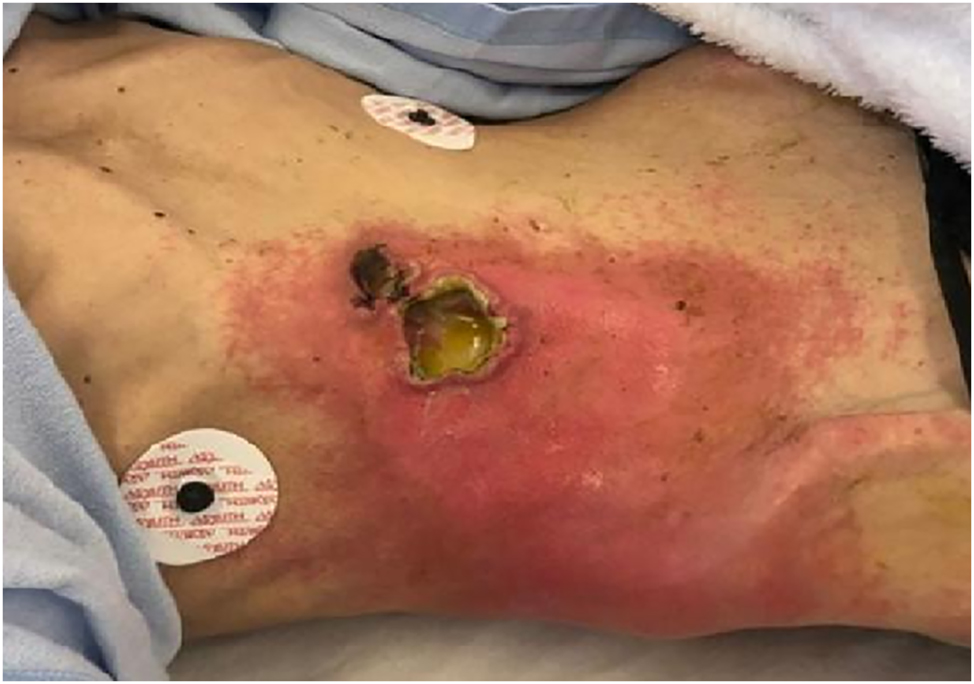 Figure 1:
Abscess formation on the right anterior abdominal wall due to duodenocutaneous fistula.