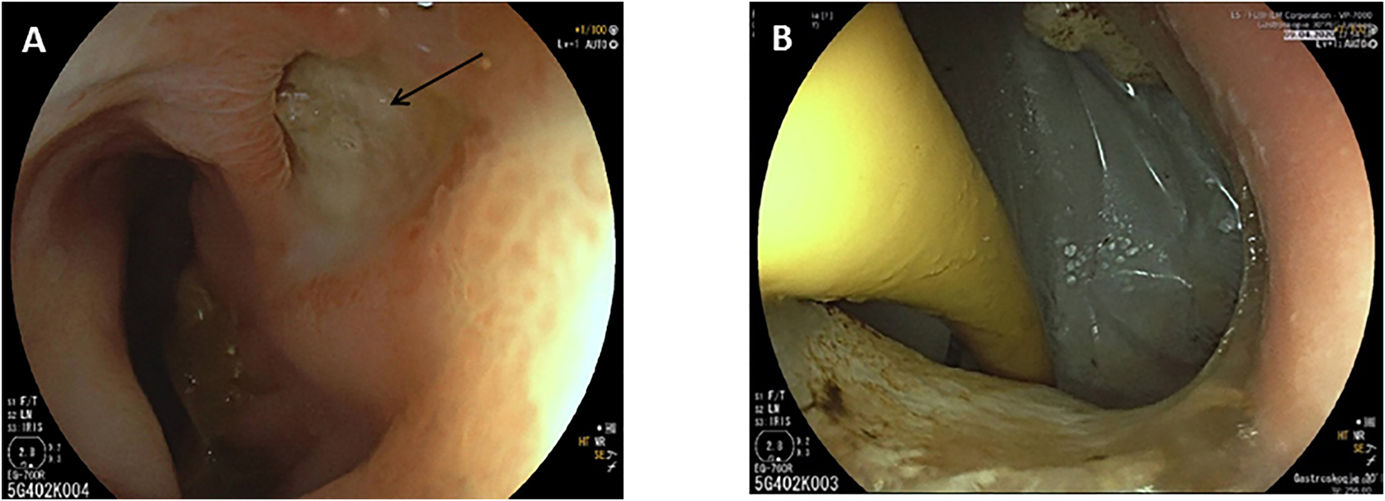 Figure 2:
Endoscopic image showing the duodenal ulcer (A, fistula opening marked by an arrow) and the inserted Foley catheter through the fistula opening (B).
