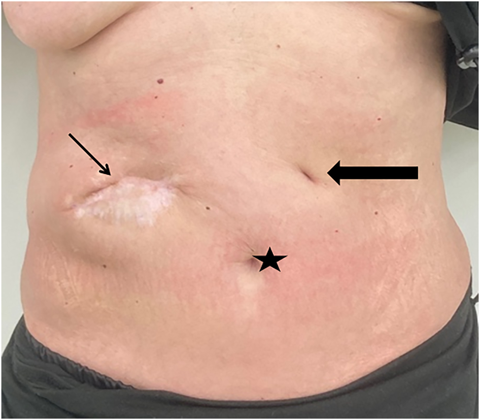 Figure 3:
Abdominal situation about two years after the initial presentation showing proper secondary healing of the abscess formation and unremarkable scar of the gastrostomy tube site. As secondary finding the patient gained weight and was in good clinical condition. Star – umbilicus; thin arrow – secondary healed abscess formation; bold arrow – scar of the gastrostomy tube.