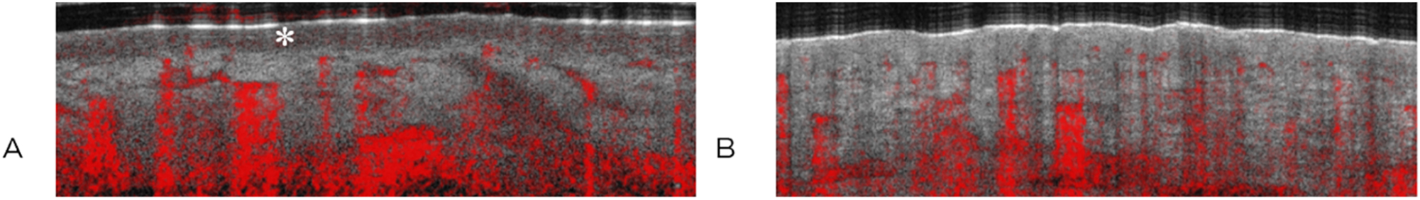 Figure 2: 
Representative images of healthy skin (A) with epidermis (∗) and thermally injured skin grade IIa (B) in comparison, sagittal view. The red color indicates movement, such as blood flow.
