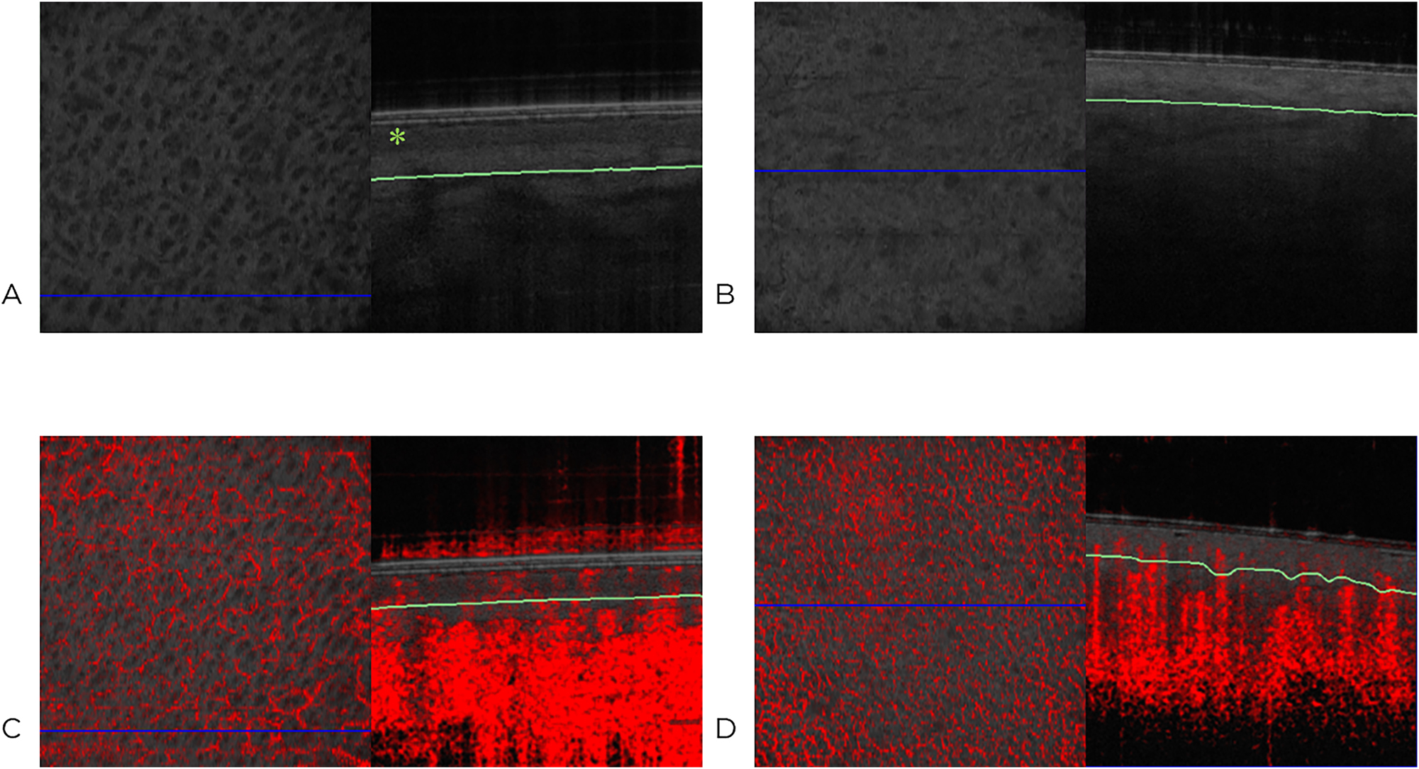 Figure 3: 
Representative optical coherence tomography images of healthy skin (A) with epidermis (*) and thermally injured skin grade IIa (B) [en-face view (left) and sagittal view (right)]. Dynamic optical coherence tomography image of healthy thoracic skin (C) and thermally injured skin (D) [en-face view (left) and sagittal view of the vascular plexus (right)]. The green line marks the depth of measurement of the plexus, and the blue line marks the location of the sagittal section shown on the right in the scanned area. The red color indicates motion, such as blood flow.
